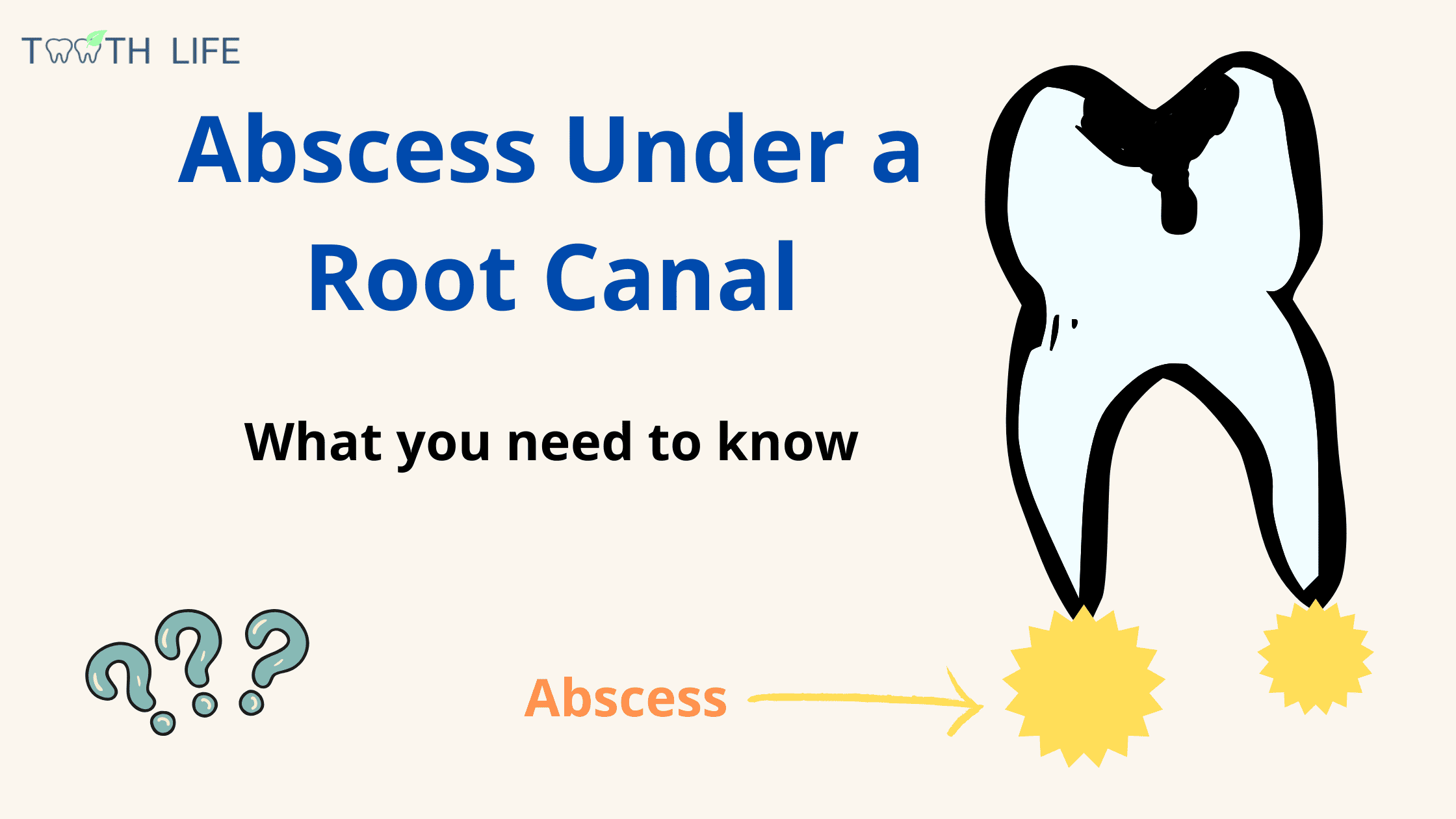 Abscess under a root canal tooth
