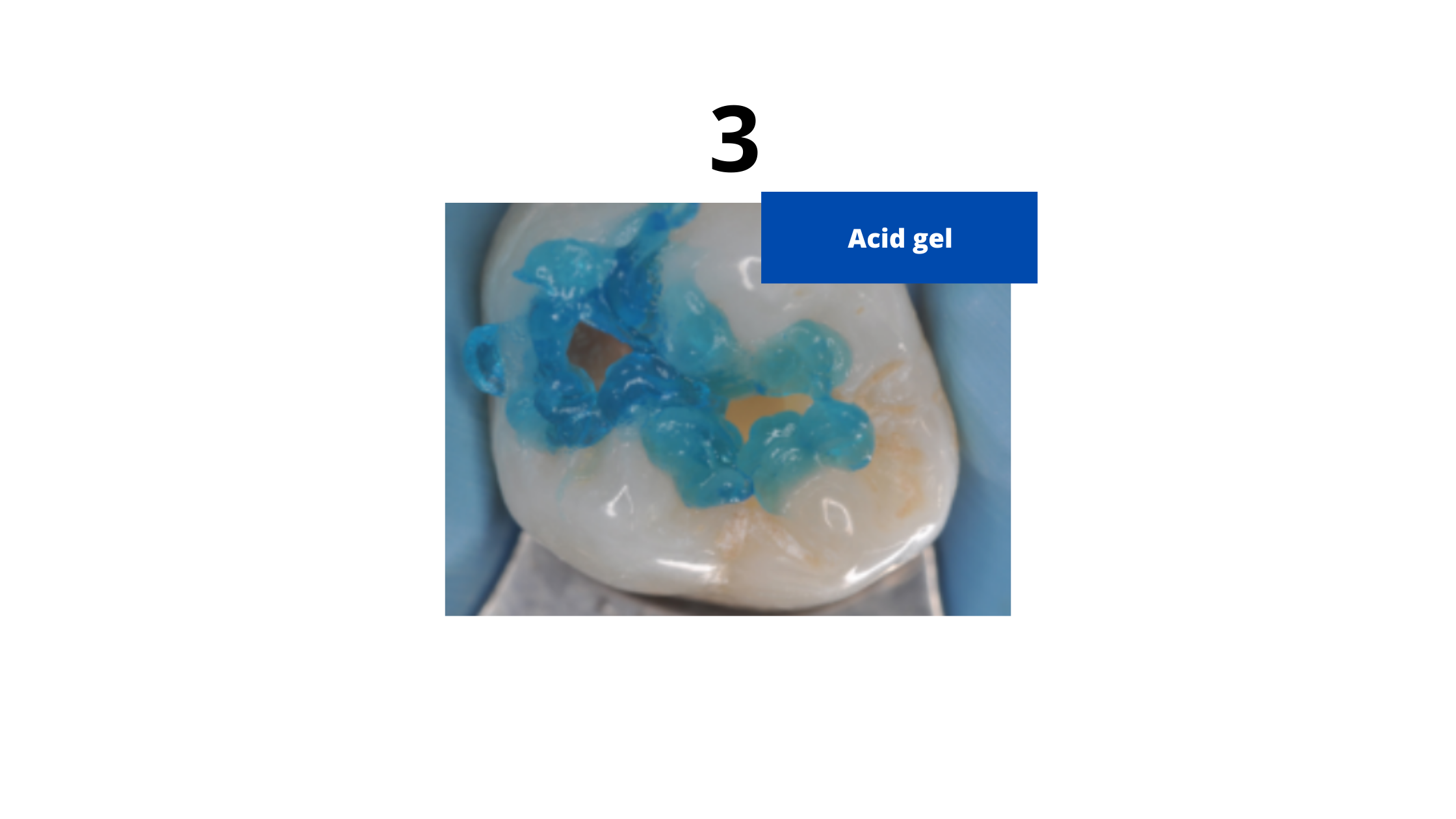 applying acid gel to the tooth