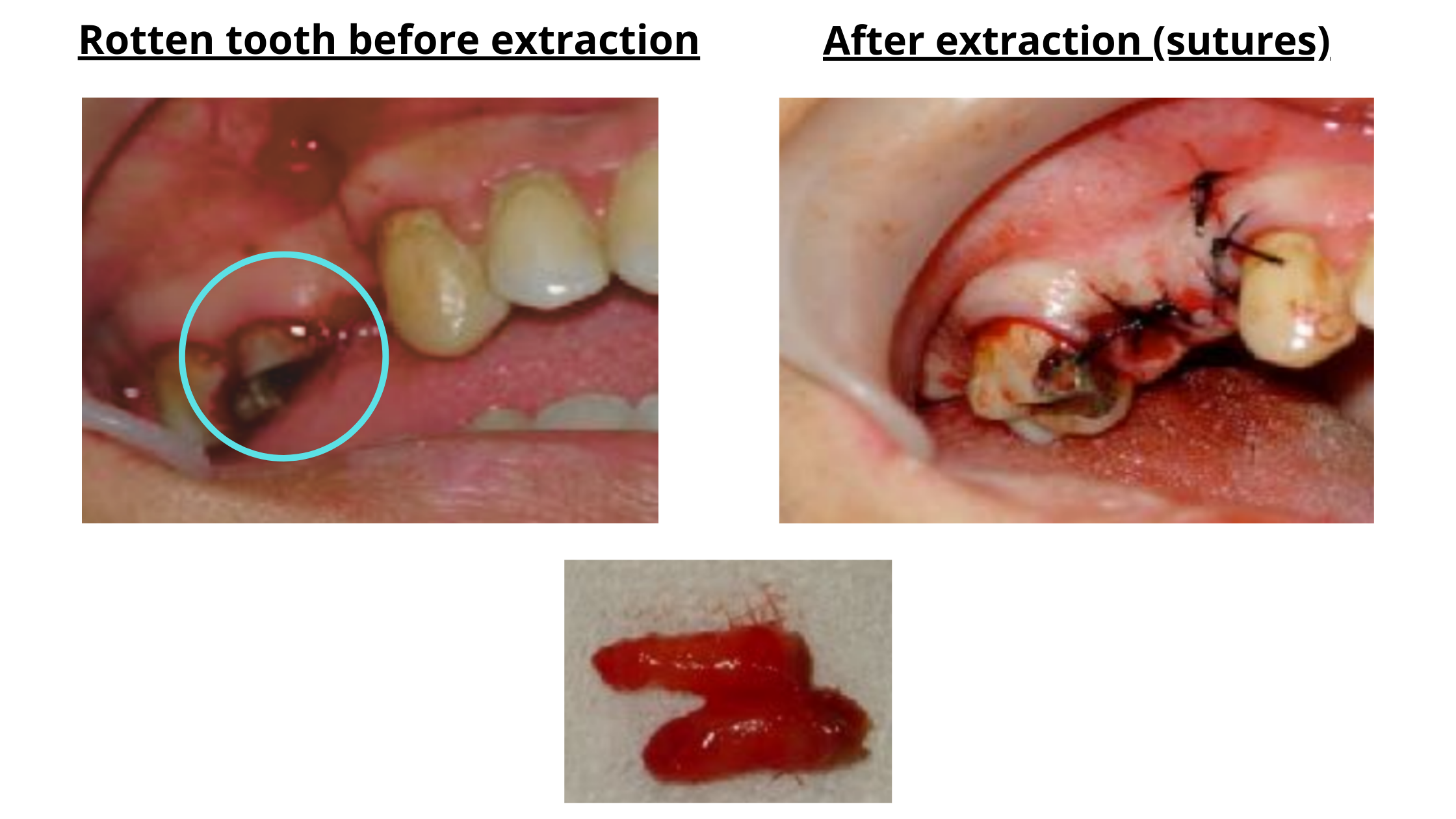 Clinical images of rotten tooth extraction by alveolectomy: Before and After