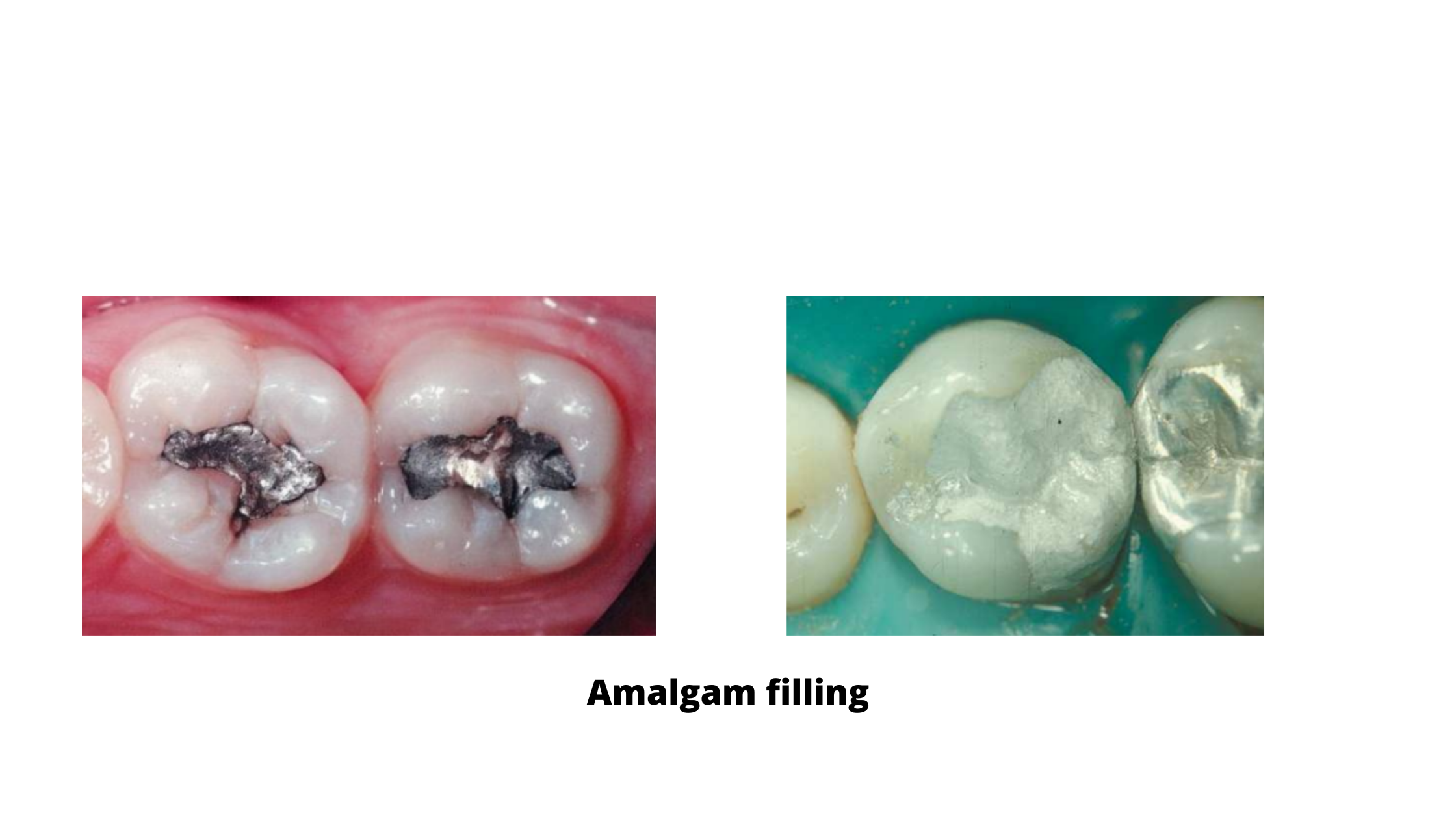 amalgam filling of back teeth