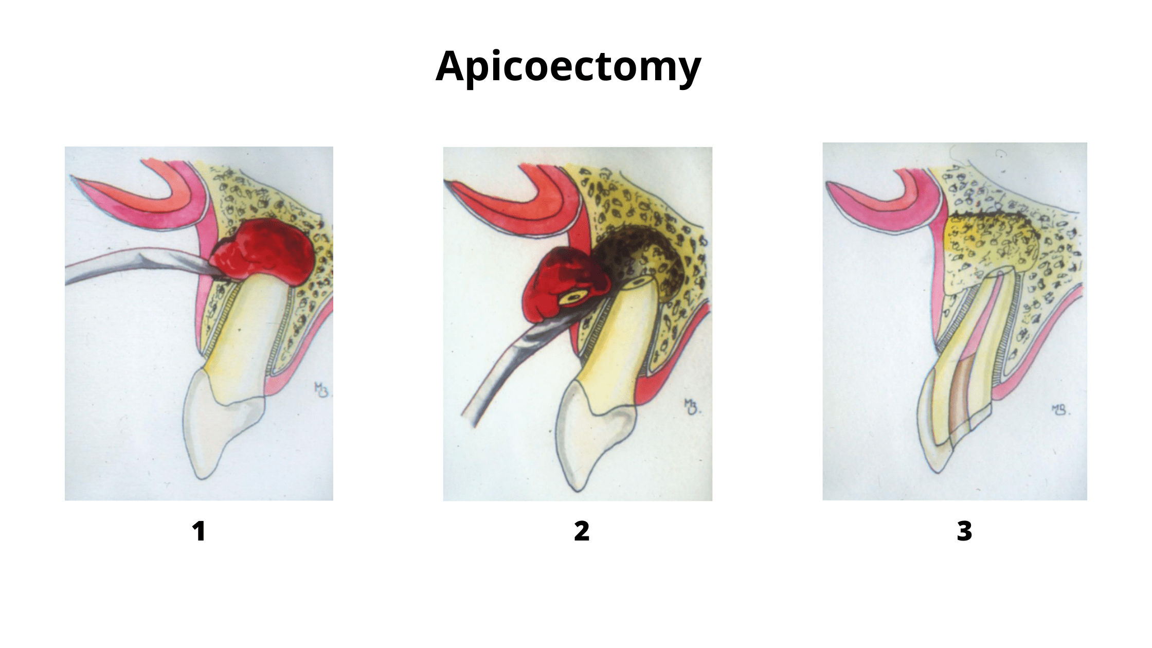 apicoectomy procedure