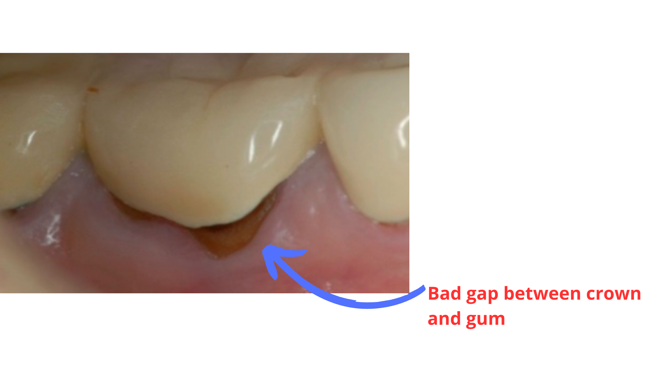 Bad gap between crown and gum (clinical image showing signs of darkening and decay along the gingival line)