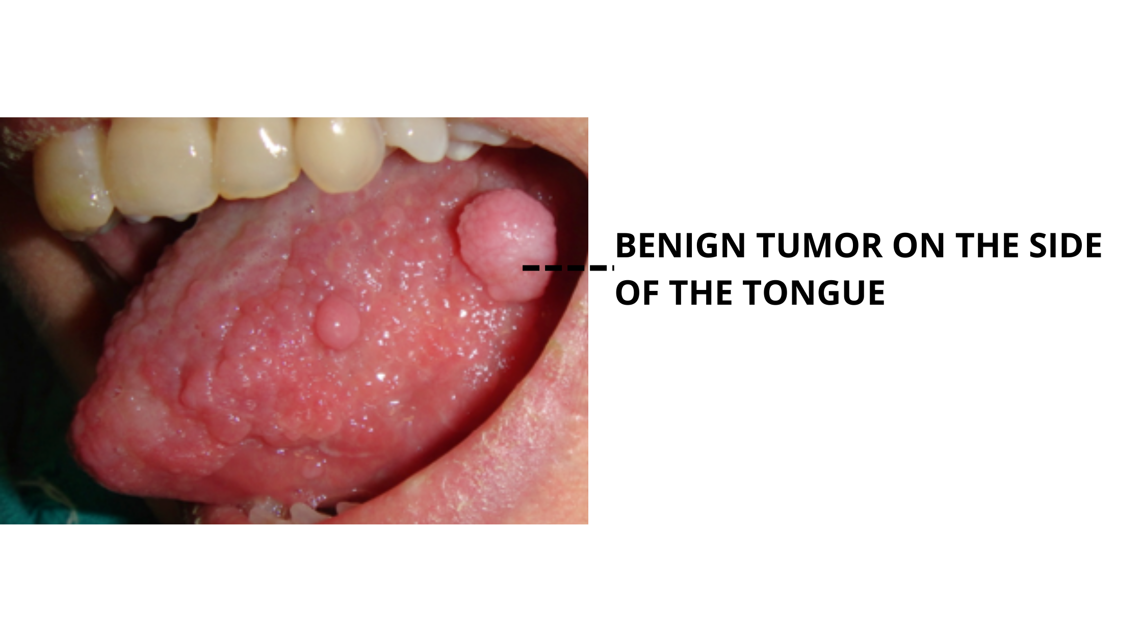 Benign tumor (Fibroepithelial hyperplasia) on side of tongue