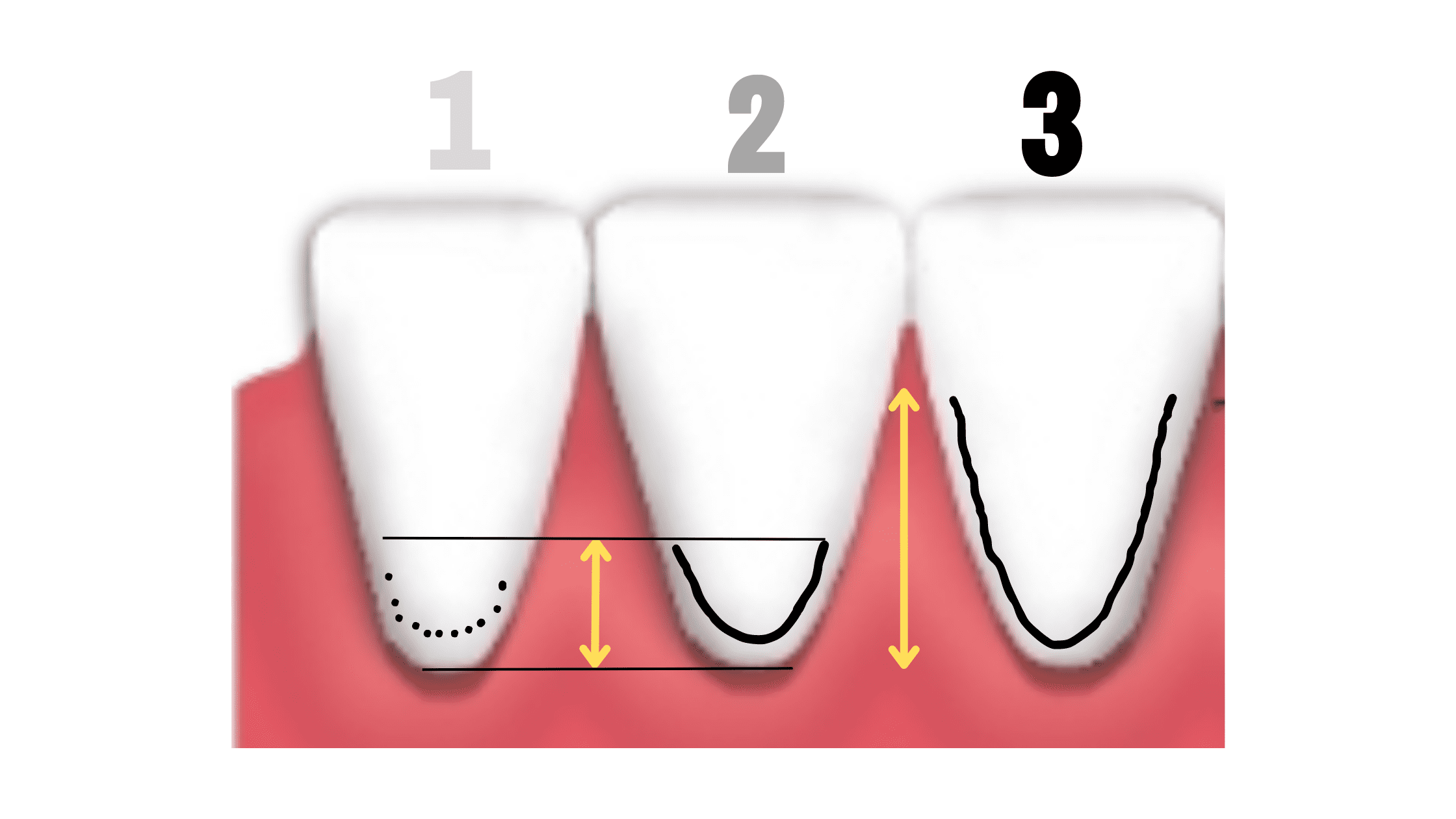 The classification of black line stains on teeth according to Gasparetto et al.