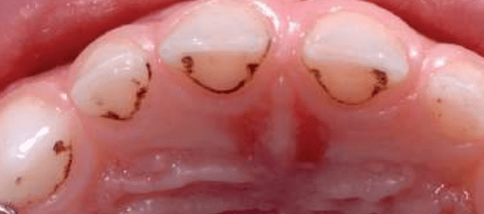 black line stains on teeth