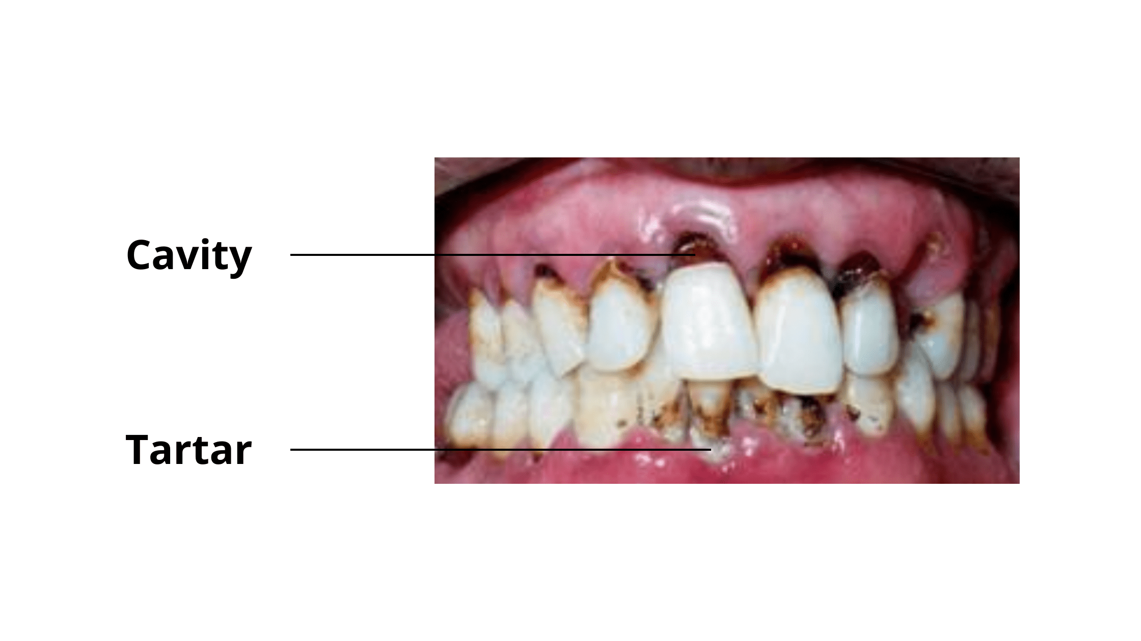 Black tartar vs cavity: a clinical image