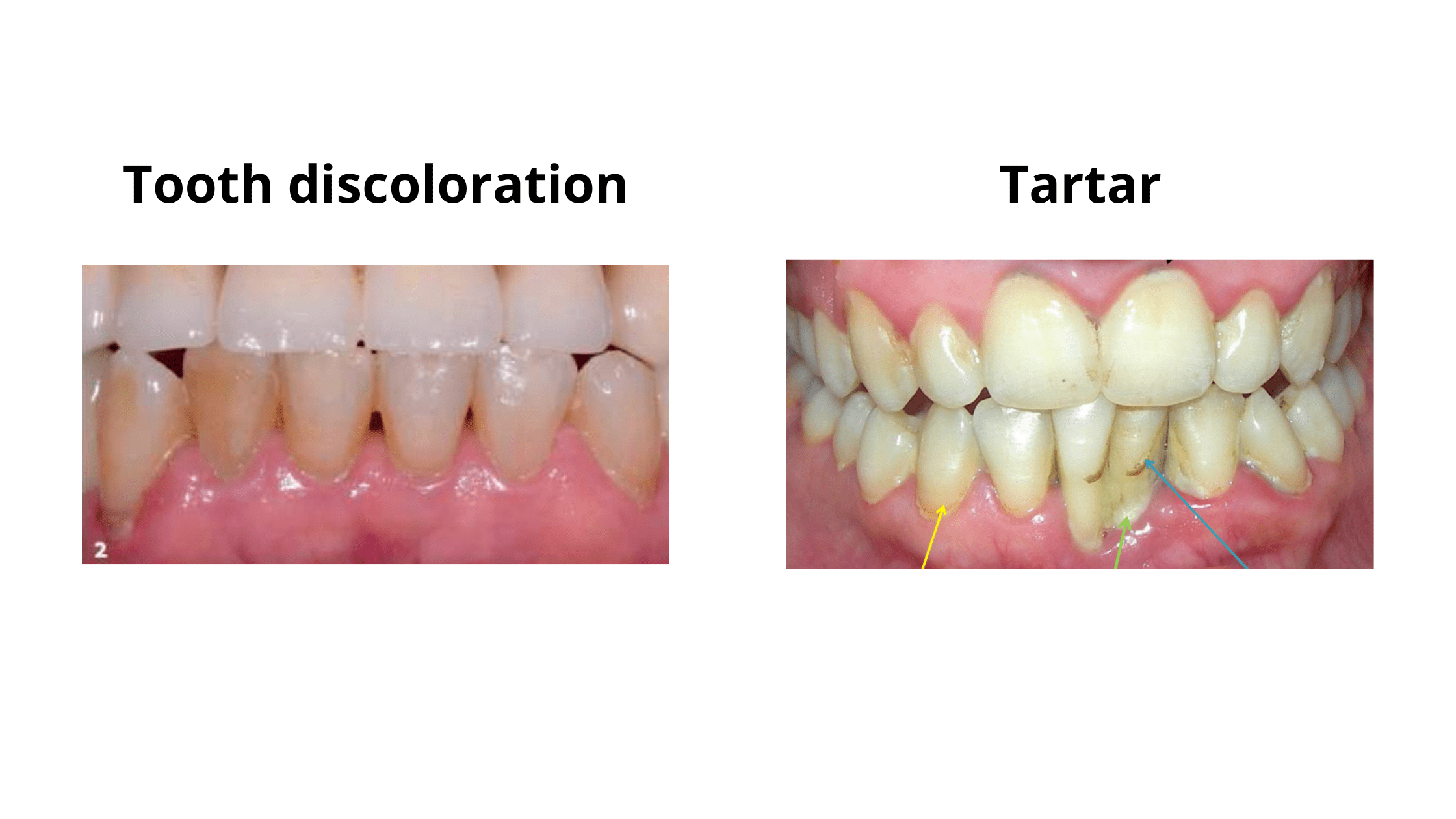 Black tartar vs. black discoloration