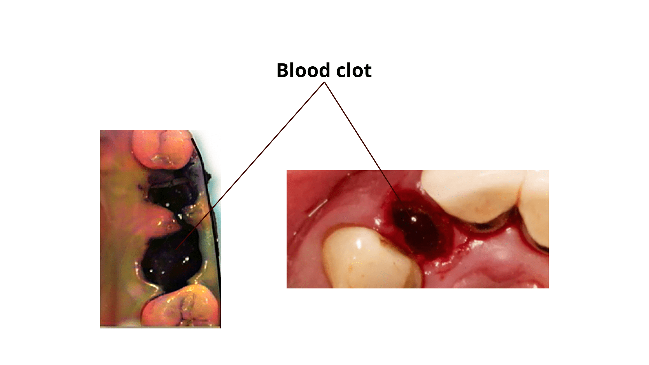 clinical images of blood clots after dental extraction