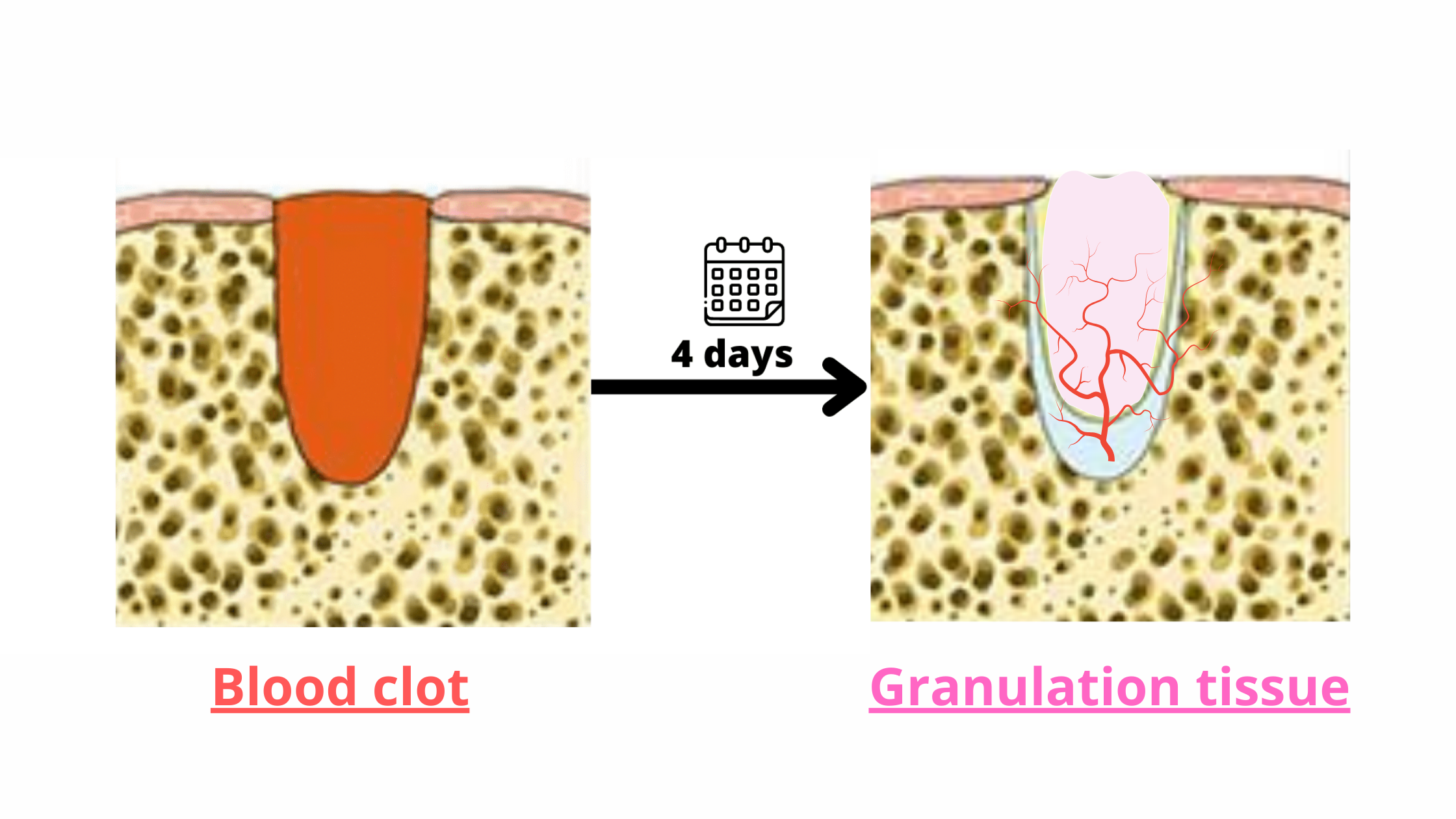 the blood clot turns into granulation tissue after about 3-4 days
