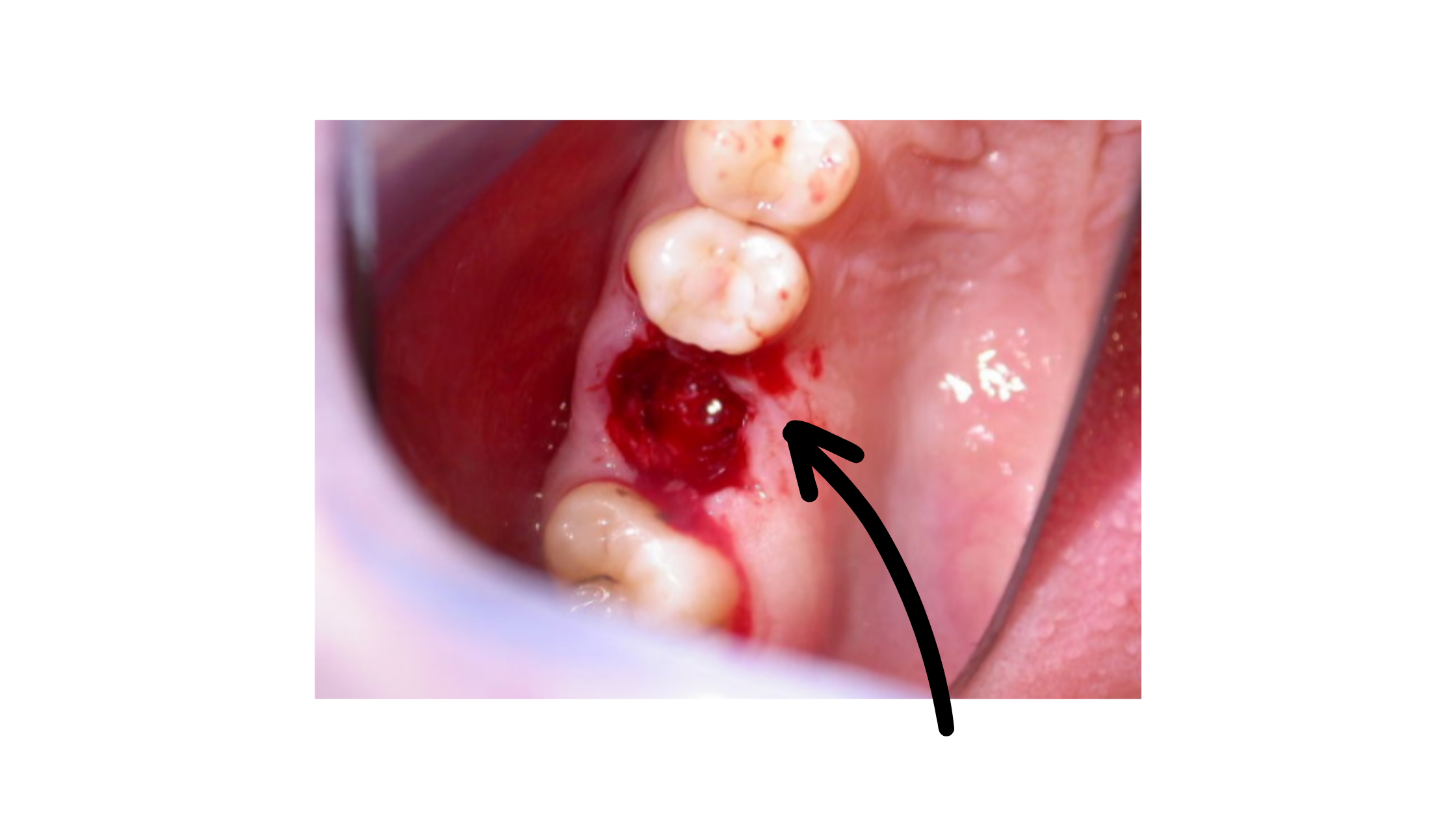 blood-clot-immediately-after-first-molar-extraction