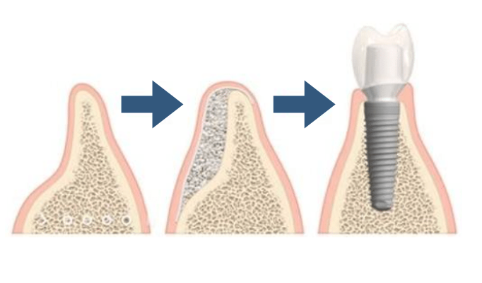 bone graft for implant placement