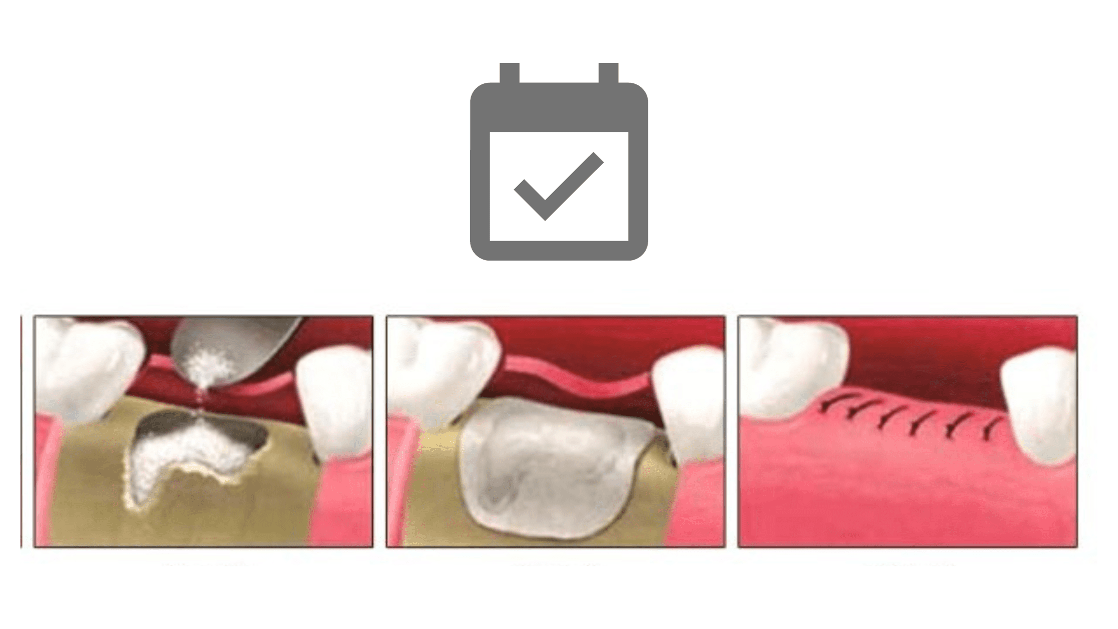The Different Healing Stages Of A Dental Bone Graft