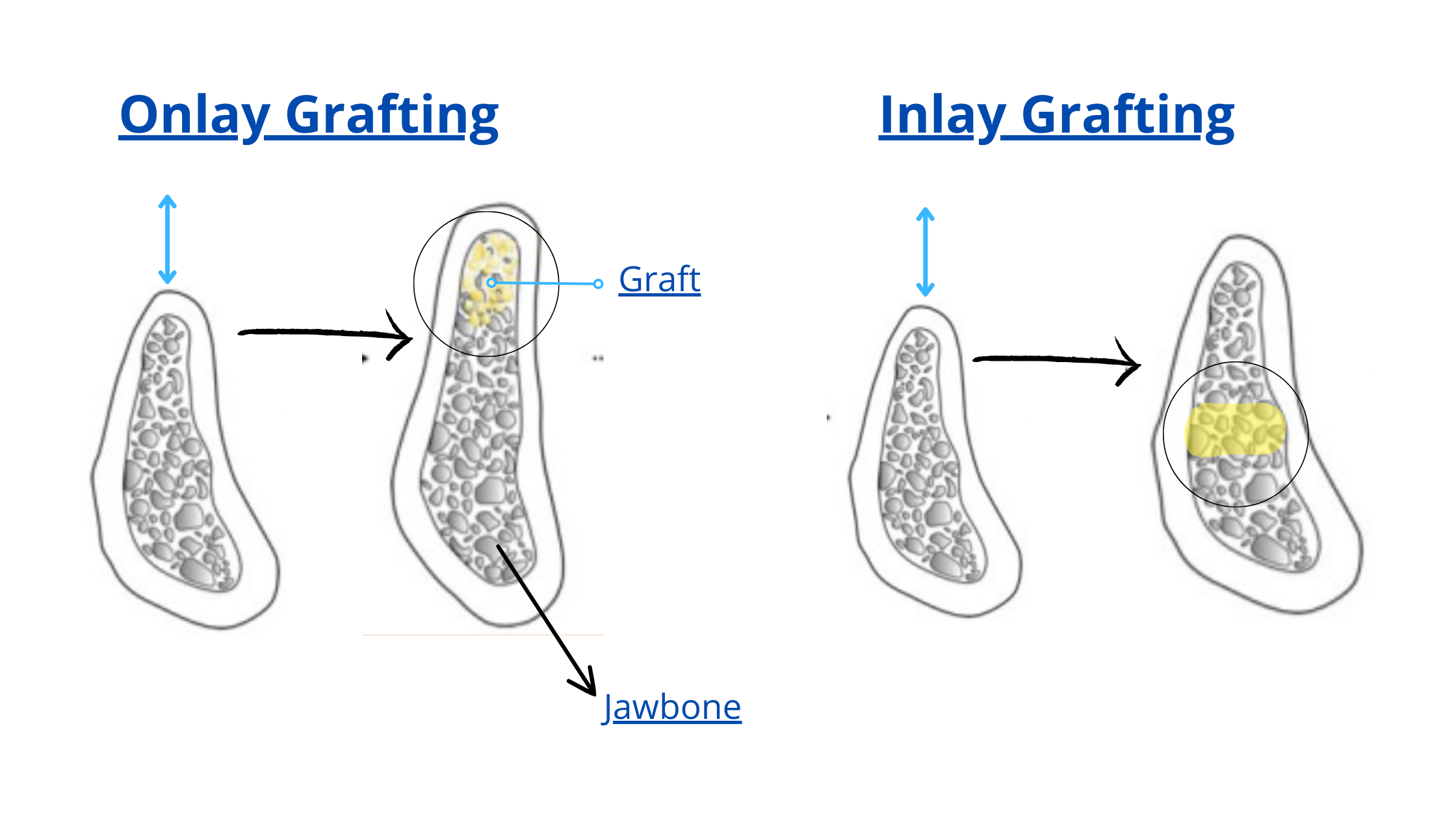onlay and inlay bone grafting