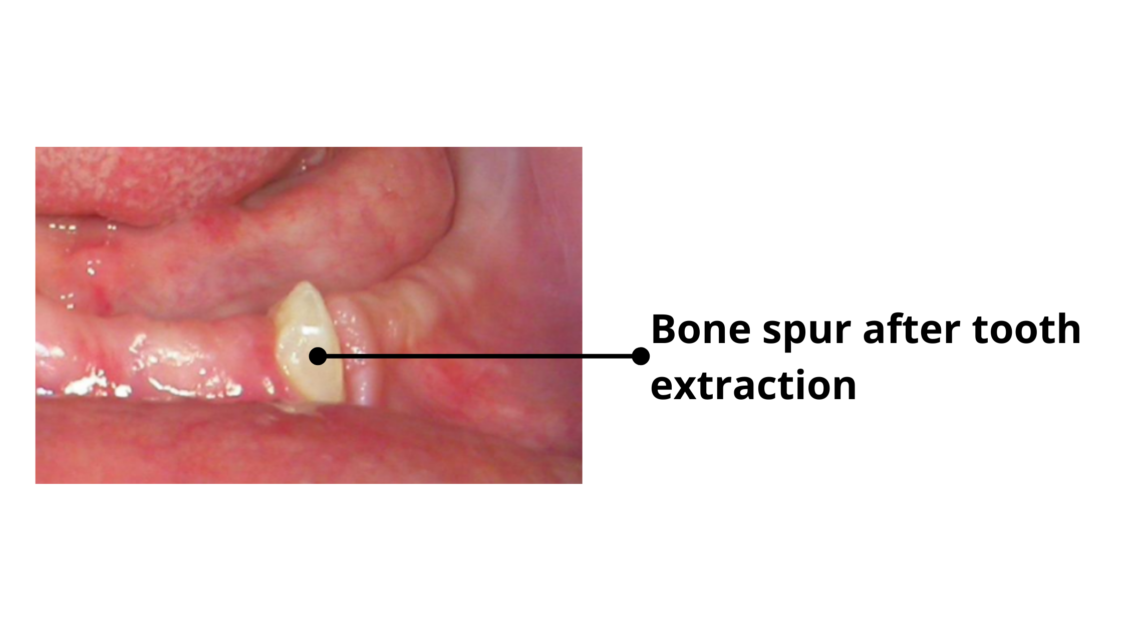 Clinical image of bone spur showing up after tooth extraction