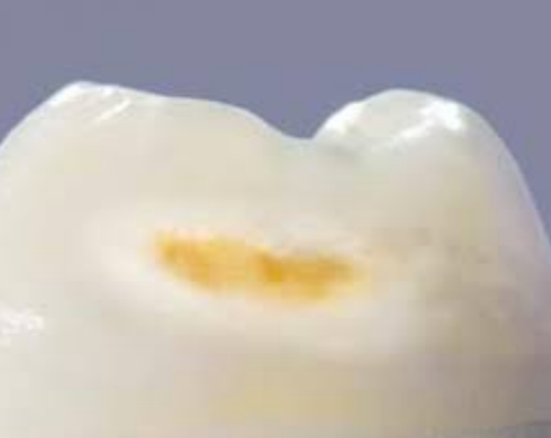 Brown spot on a tooth due to the start of a tooth decay