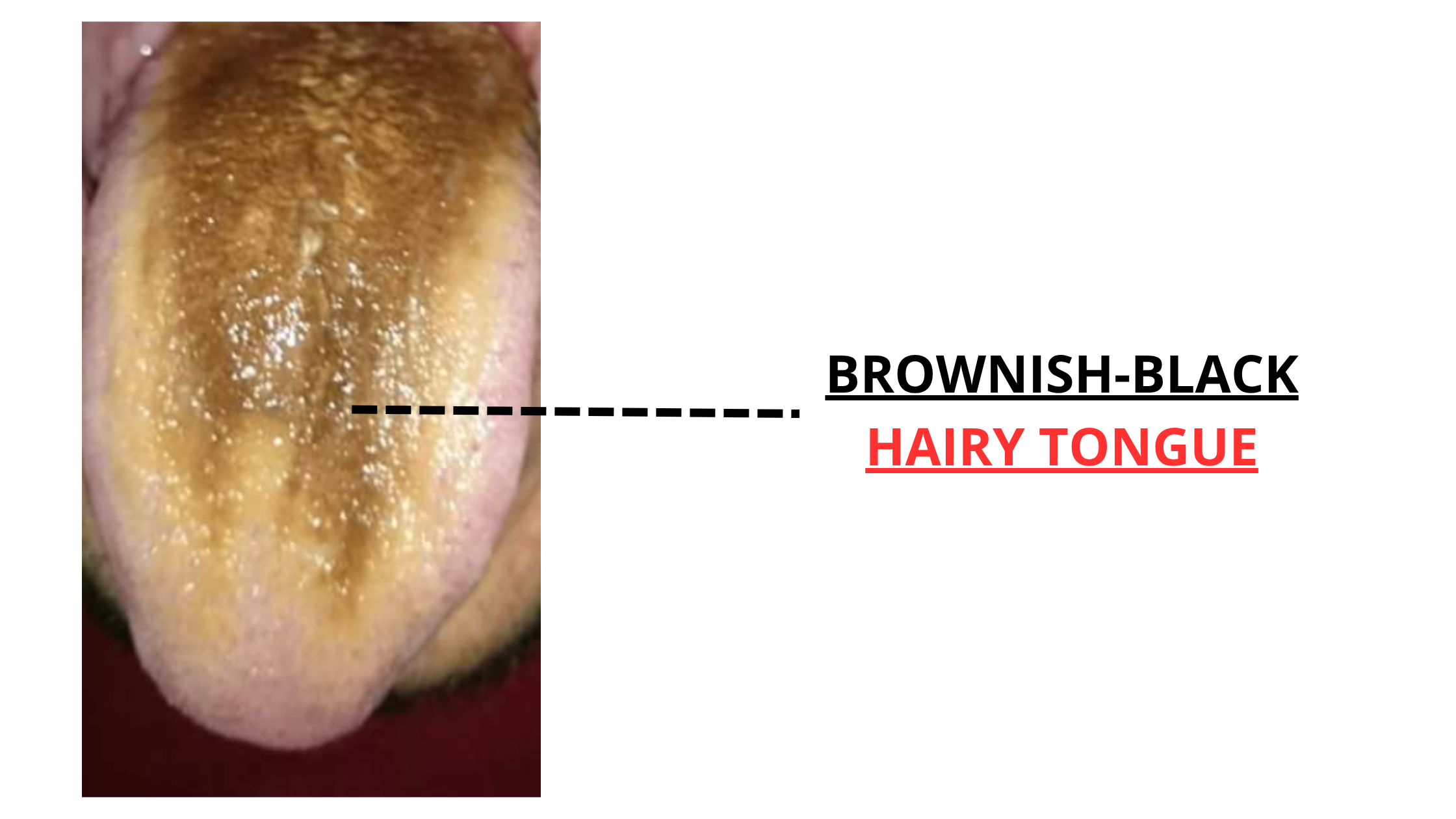 Black hairy tongue