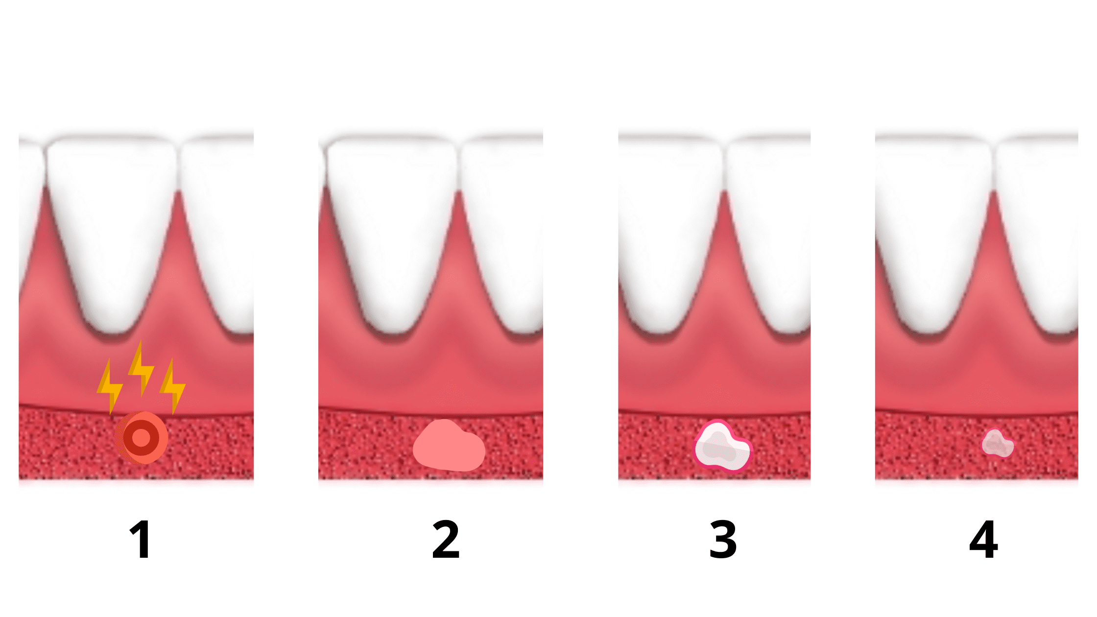 Canker sore on the gum stages