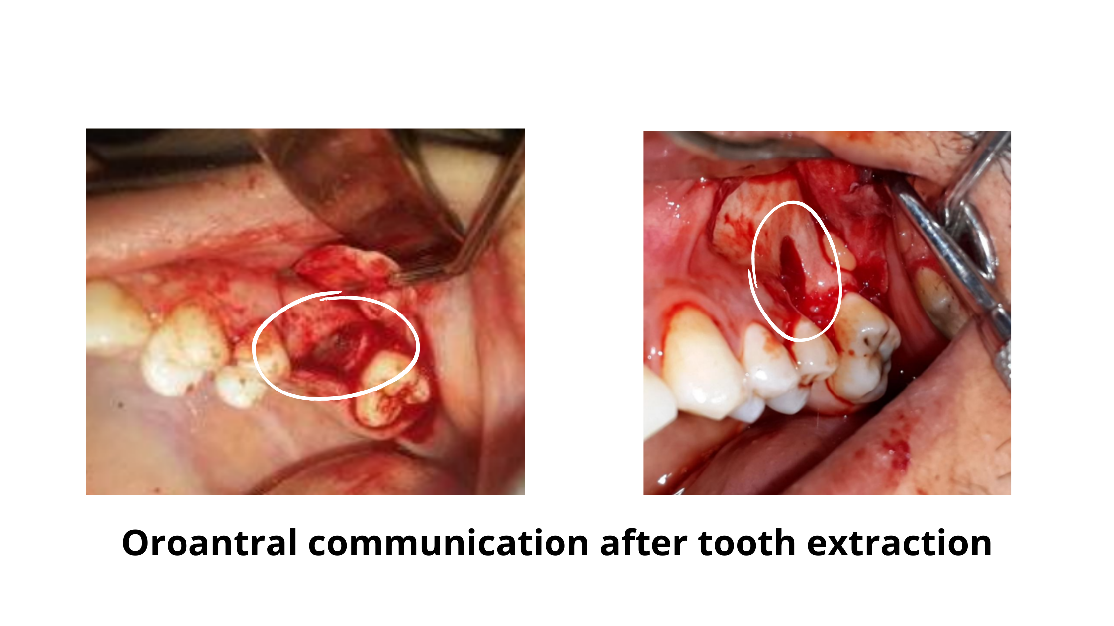 Clinical cases of sinus perforation following upper back teeth extraction