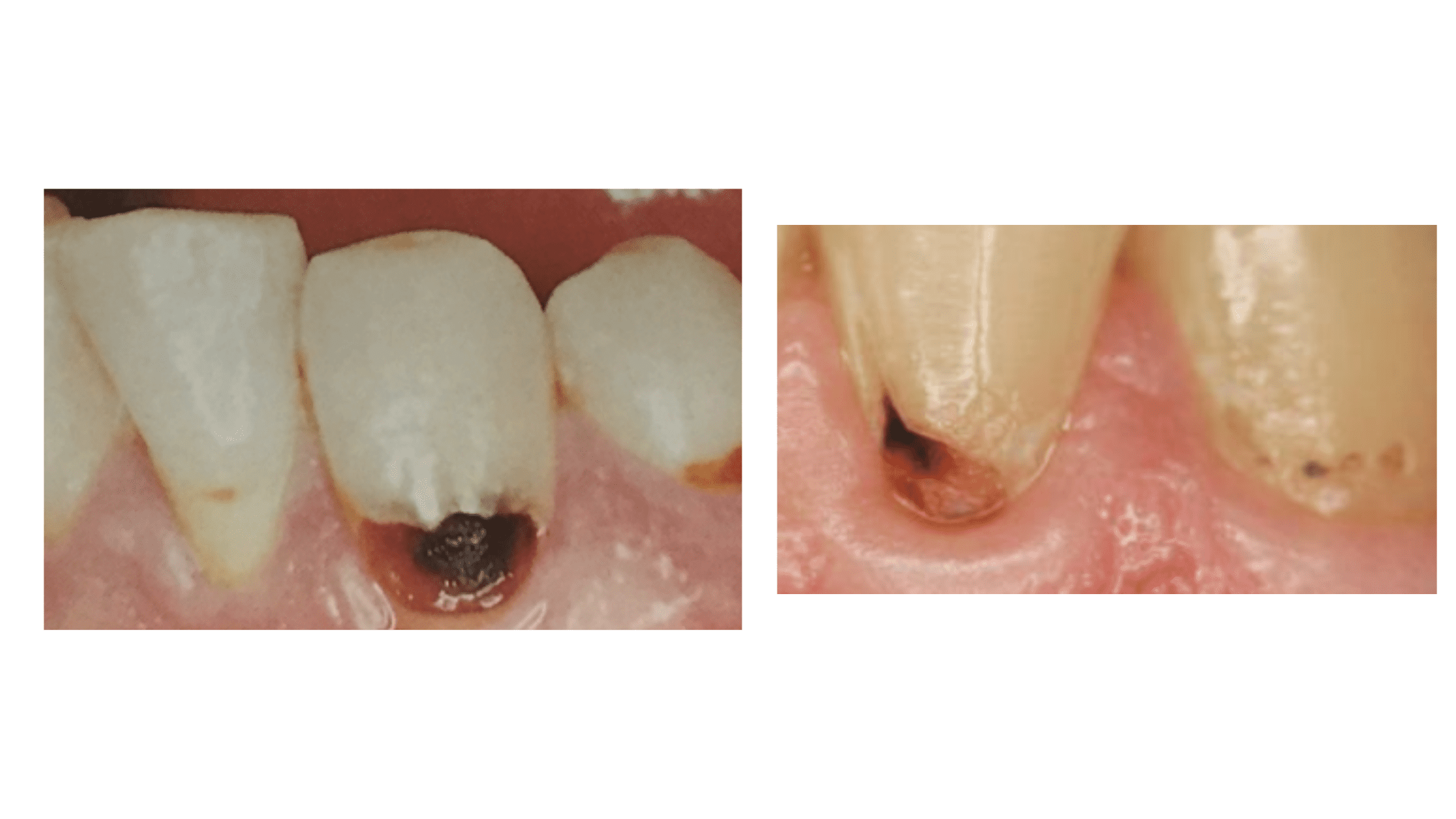 Clinical pictures of teeth decaying at gum line