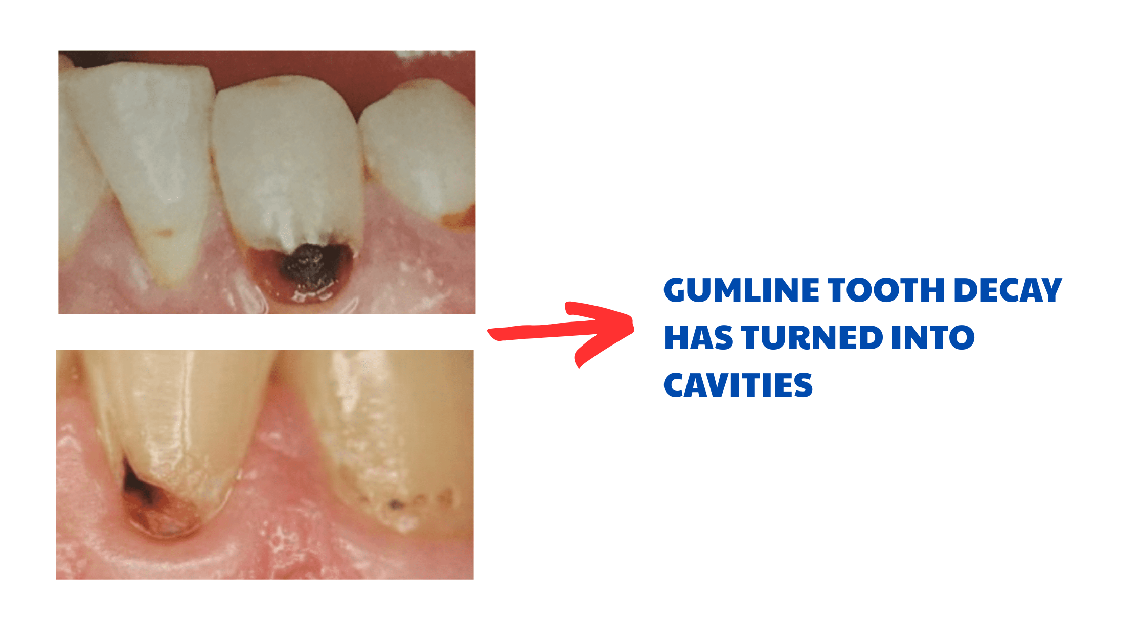 Advanced stage of tooth decay at the gum line: Cavity or hole formation