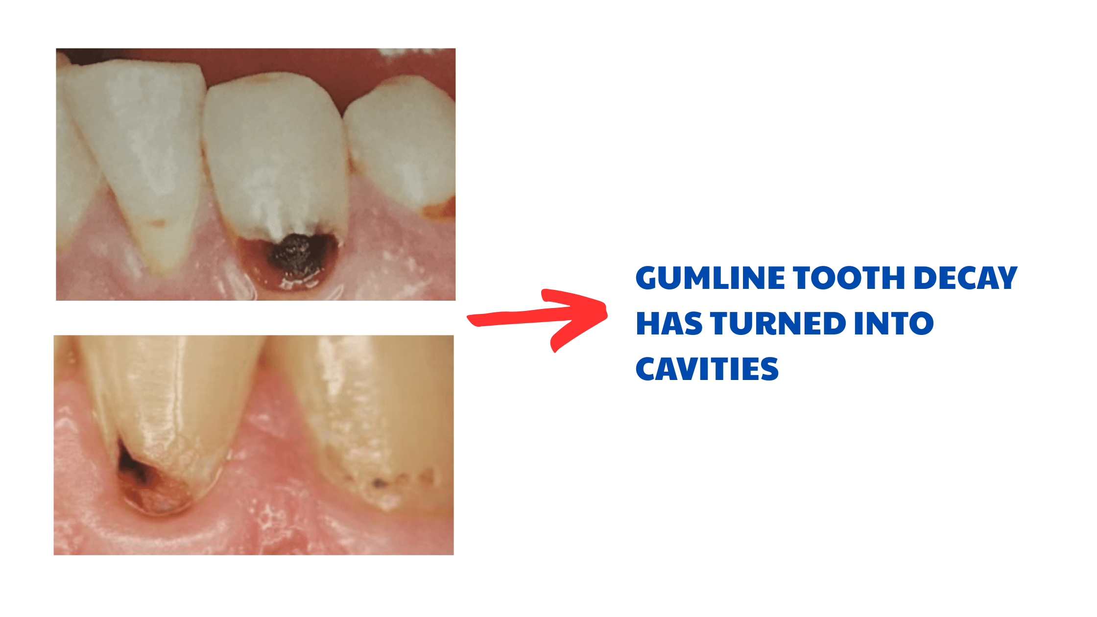 Clinical pictures of teeth decaying at gum line