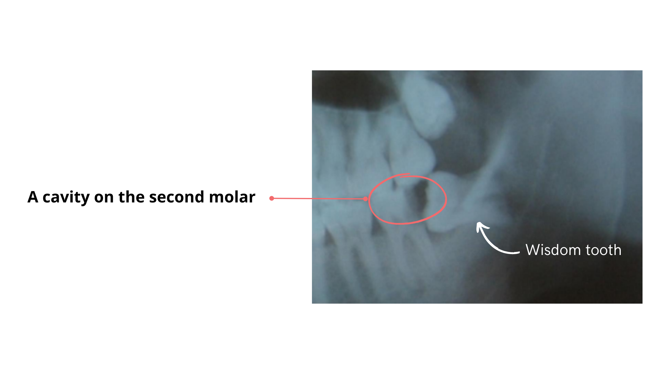 Dental X-ray showing a partially erupted wisdom tooth causing decay on the neighboring molar