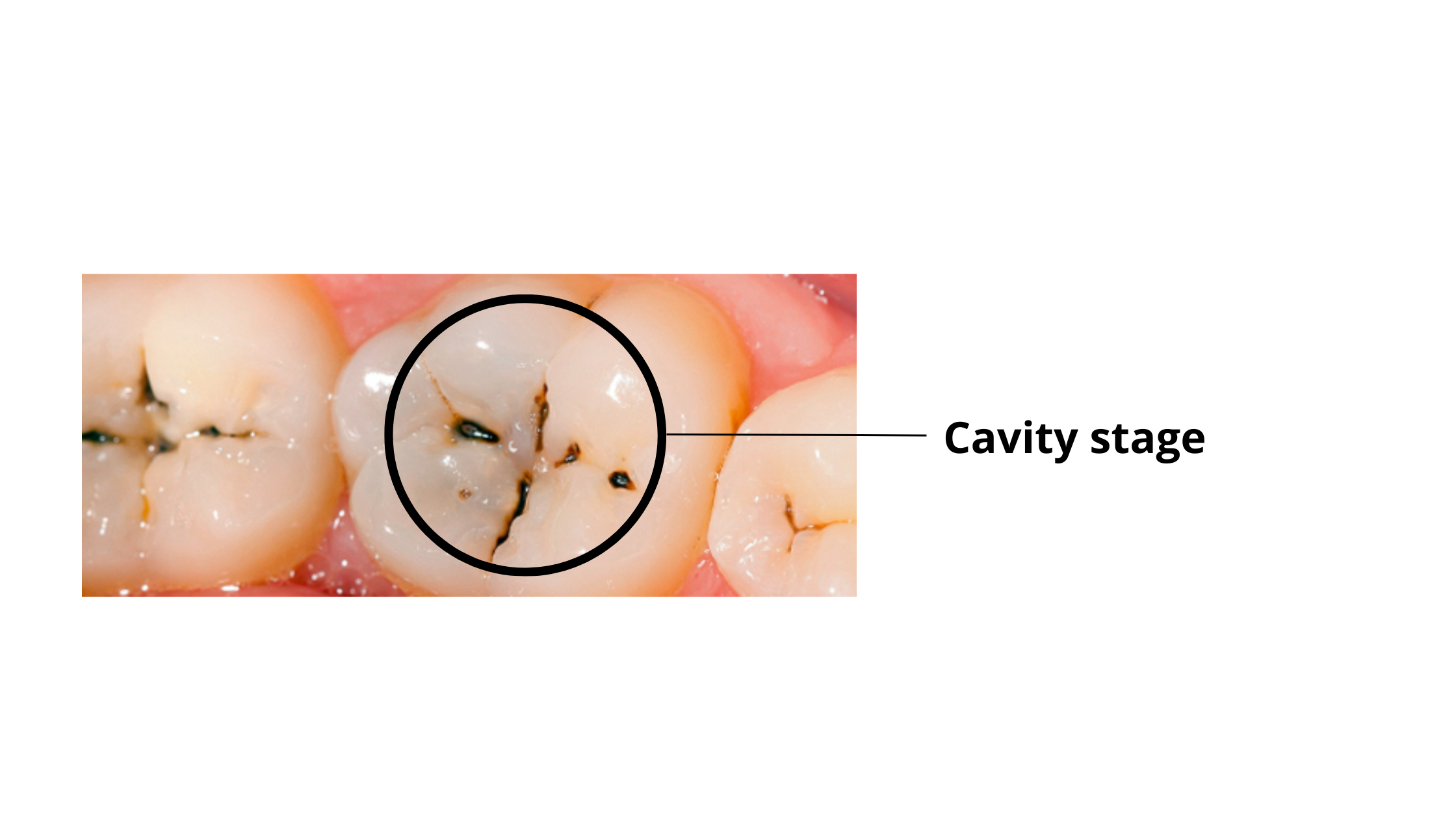 cavity stage on back teeth
