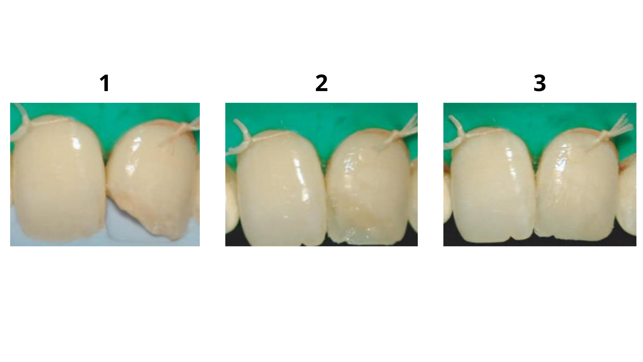composite bonding step by step to restore fractured front tooth