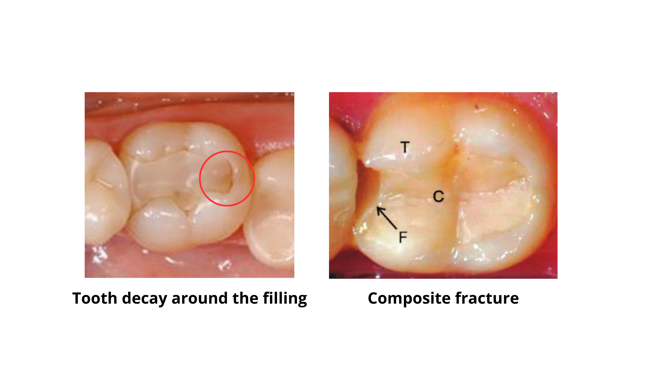 composite filling of back teeth complications: Fracture and tooth decay