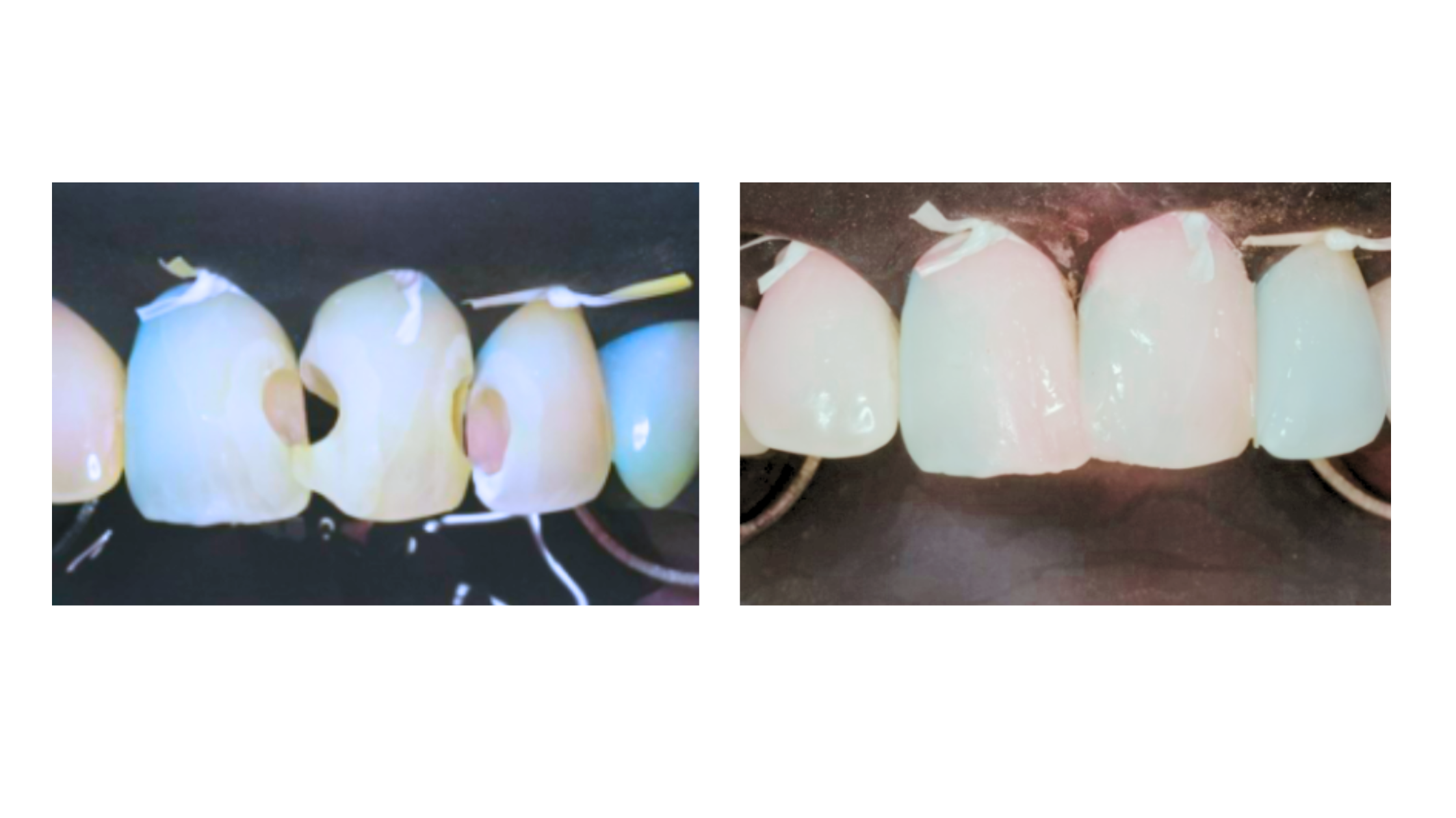 Cavity filling on the front teeth: Before and after