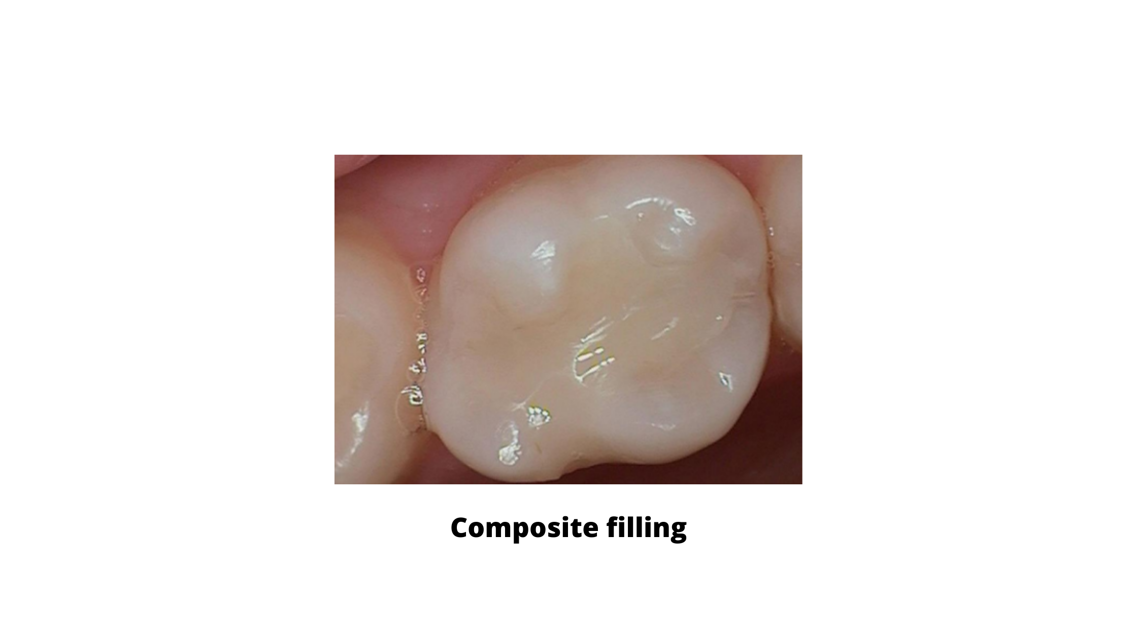 composite filling of an upper molar