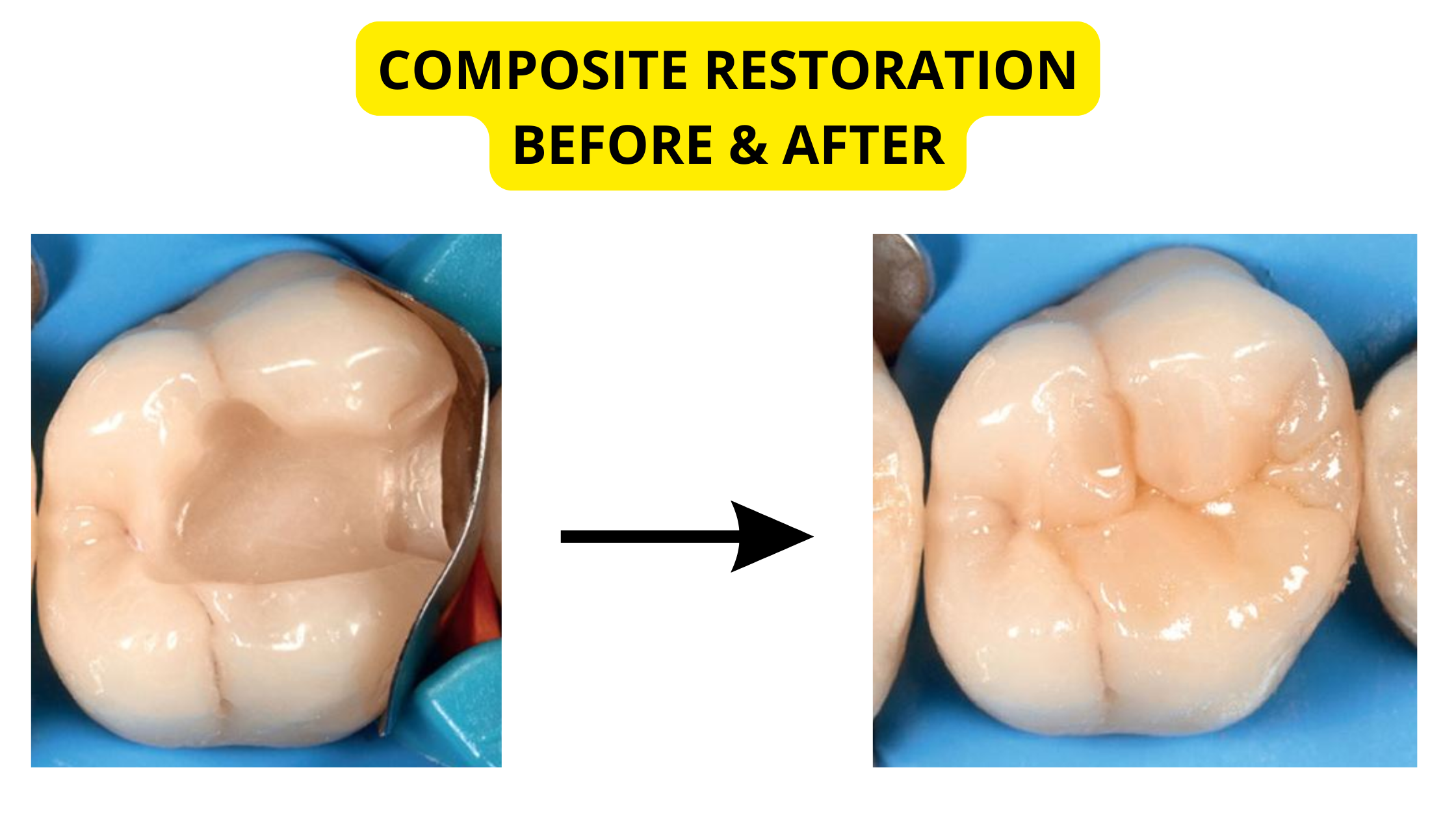 Composite restoration before and after