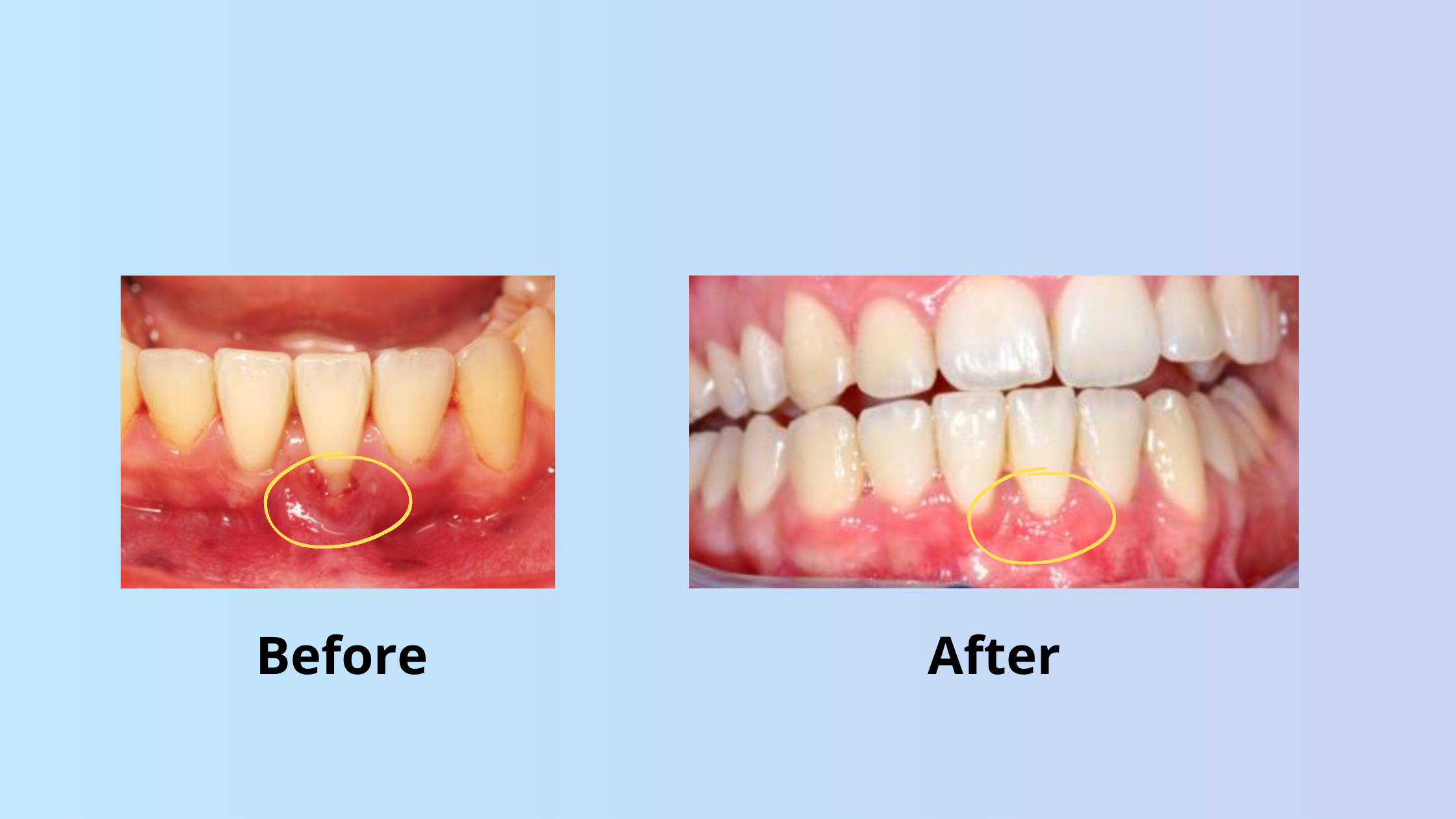 Connective tissue graft before and after: Covering a recession area next to a lower incisor 