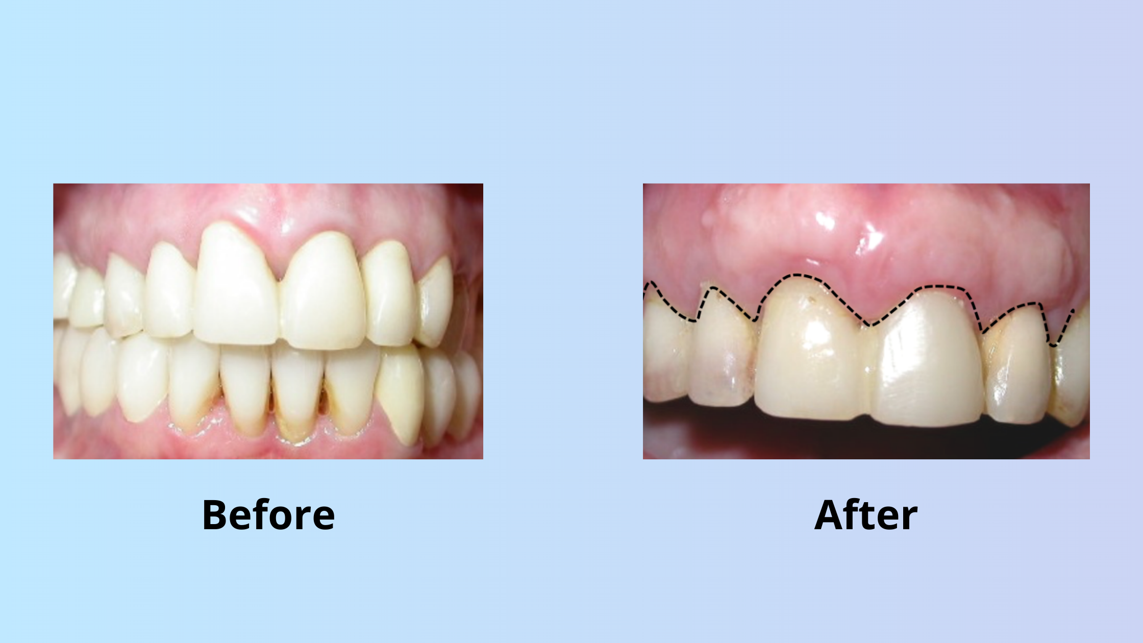Connective tissue graft before and after: Restoring the gum appearance on the upper front teeth area