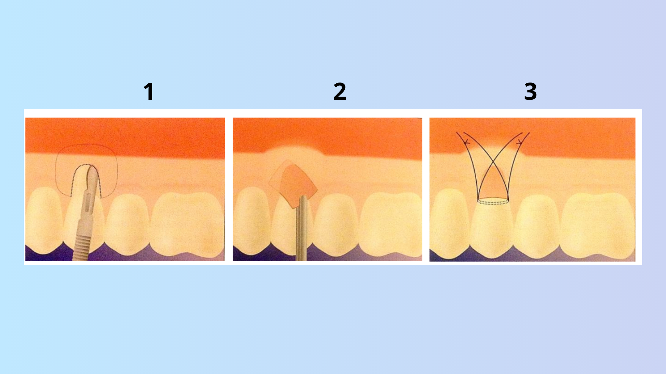 Connective tissue graft with the envelope technique
