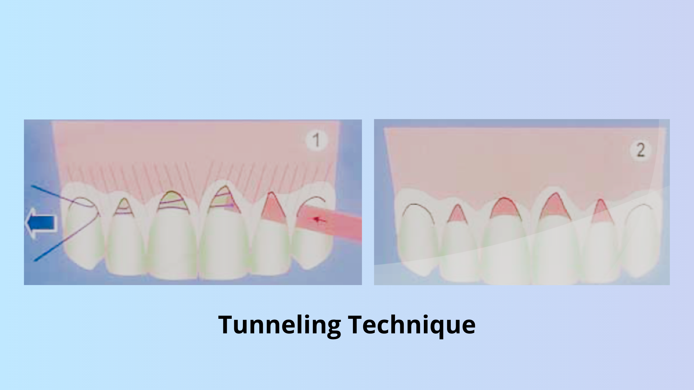Connective tissue graft with tunneling technique