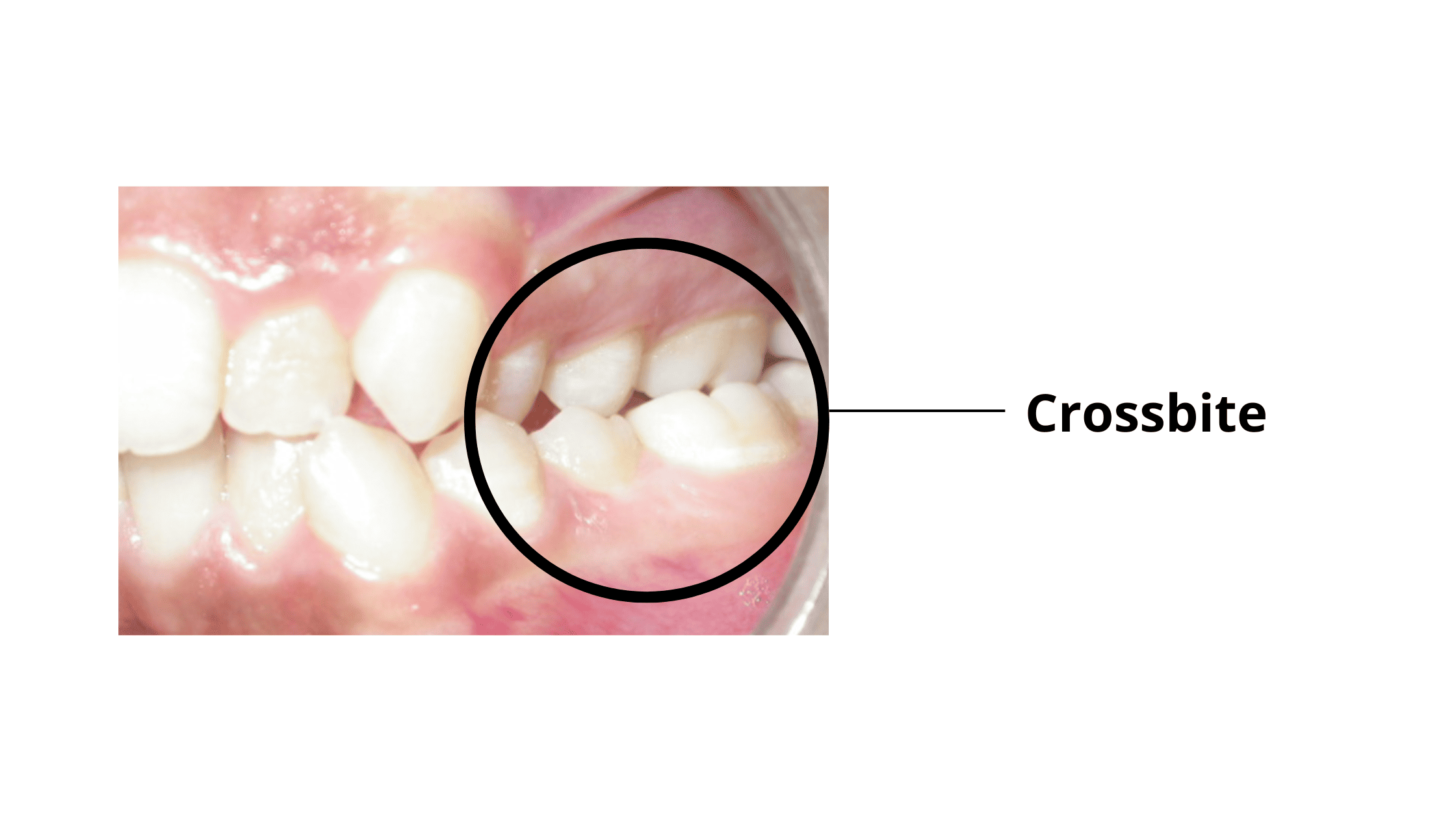 Dental crossbite: The lower molars overlapping the upper ones