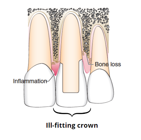 The effects of an ill-fitting crown on the gum and bone tissue