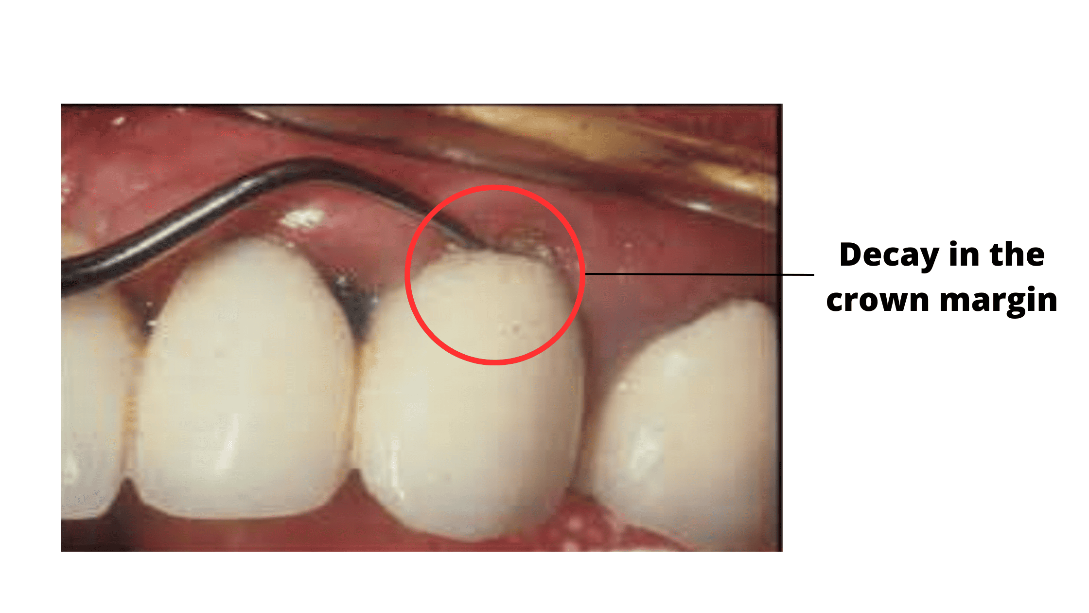 Tooth decay in the crown margin