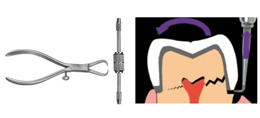 removing crown using hand instruments (pliers, crown removers)