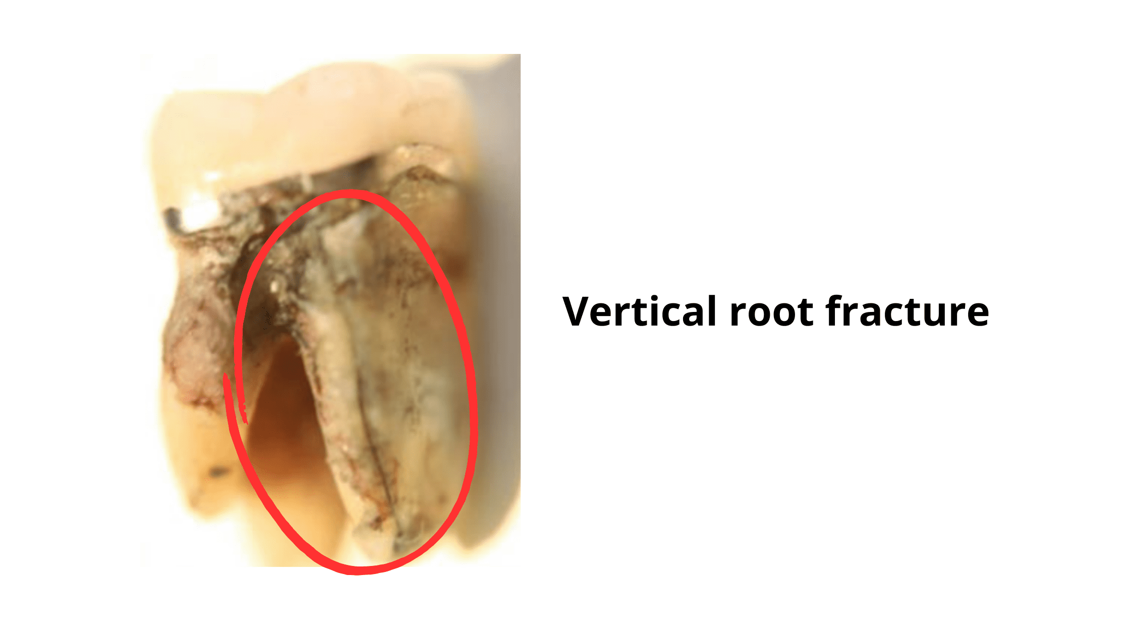 Revealing a vertical root fracture after extraction of a crowned tooth