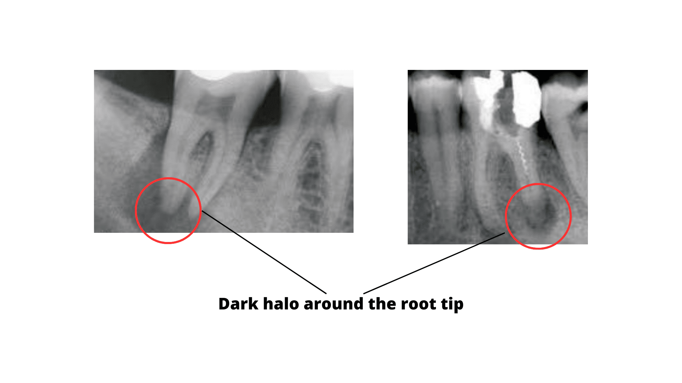 X-rays showing dark halo around the root tip