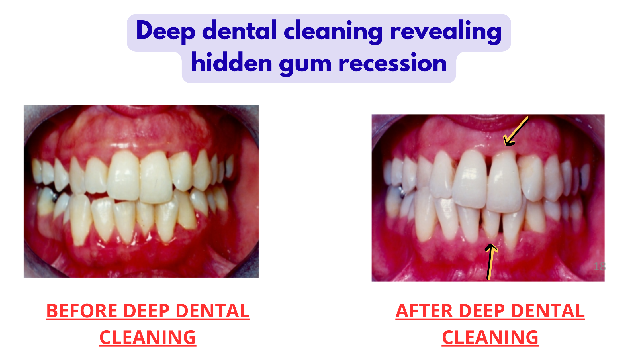 Gum recession after deep dental cleaning