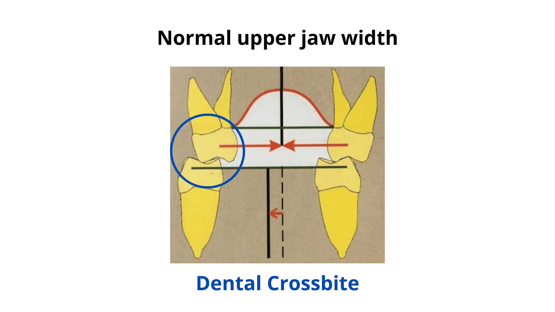 dental crossbite