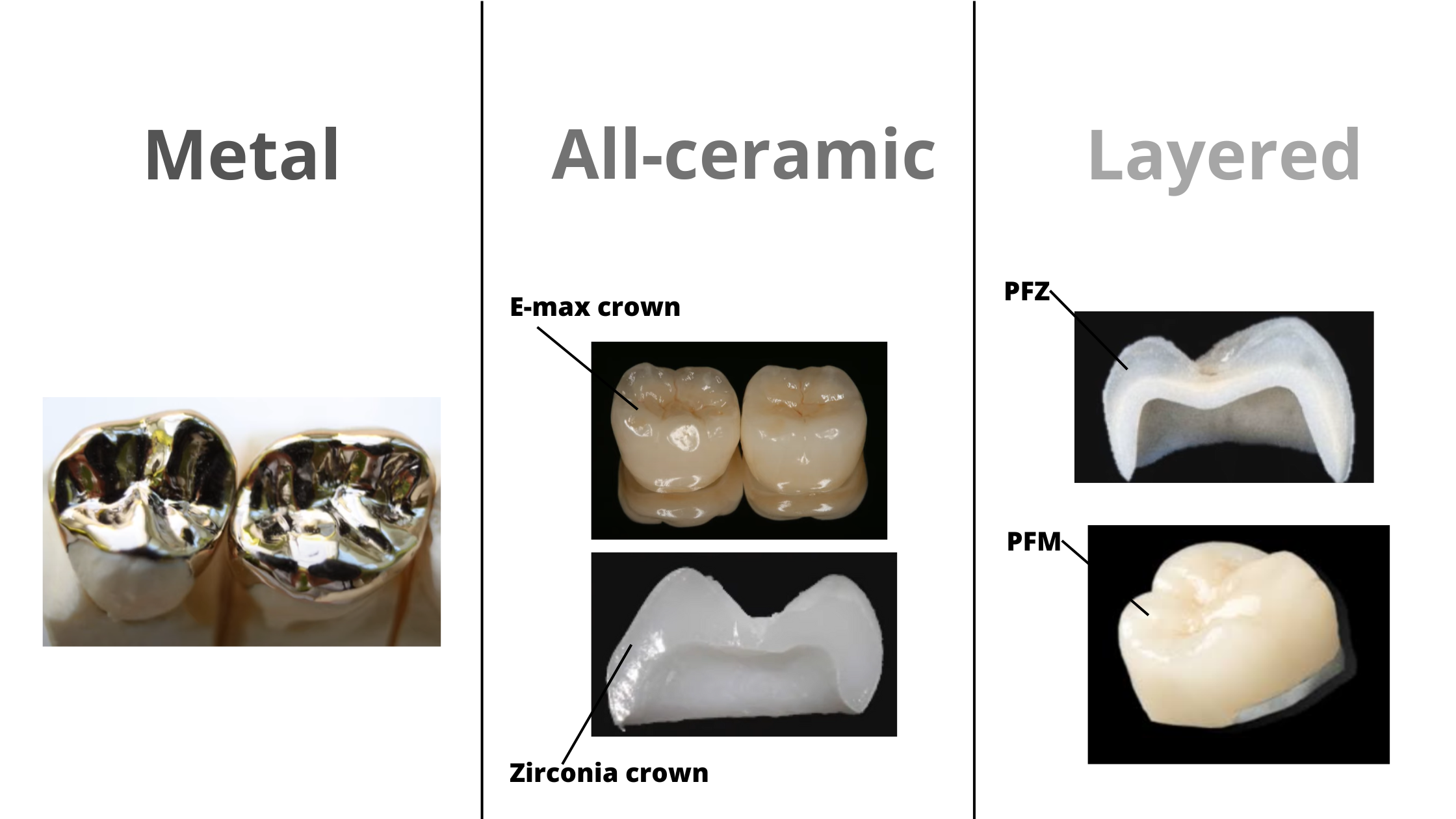 Types of dental crowns for back teeth