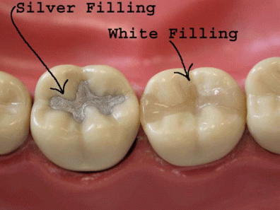 dental filling types