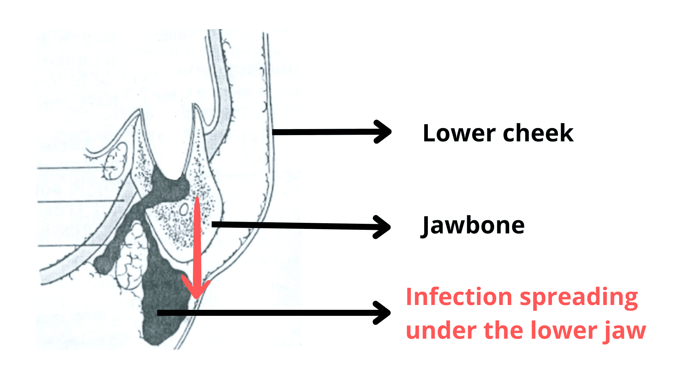 Dental infection spreading below the lower jaw