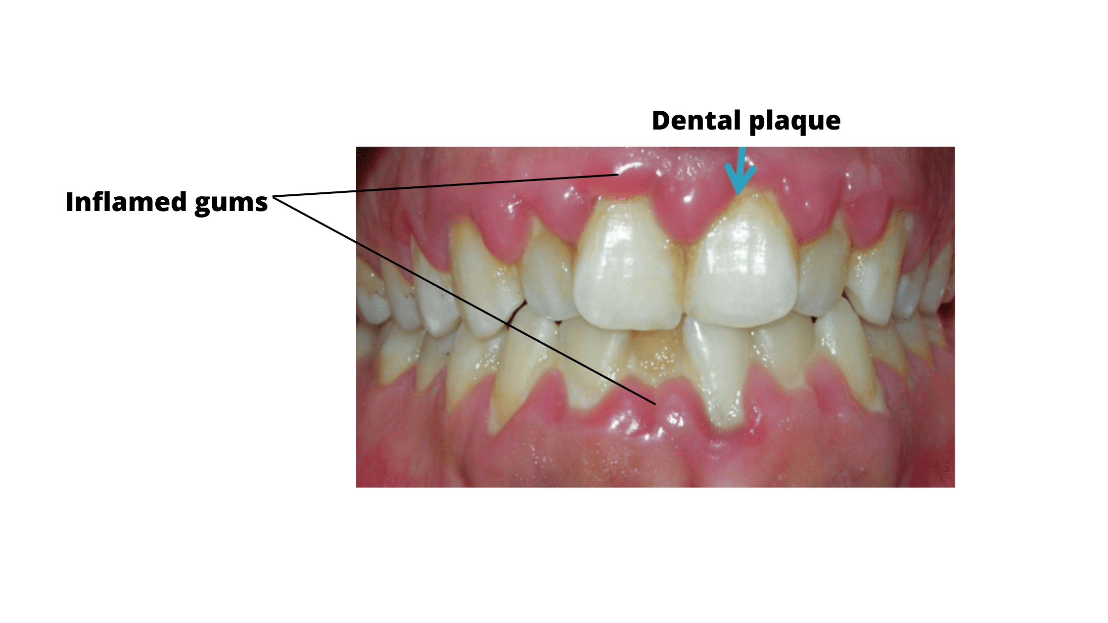 dental plaque and gum inflammation