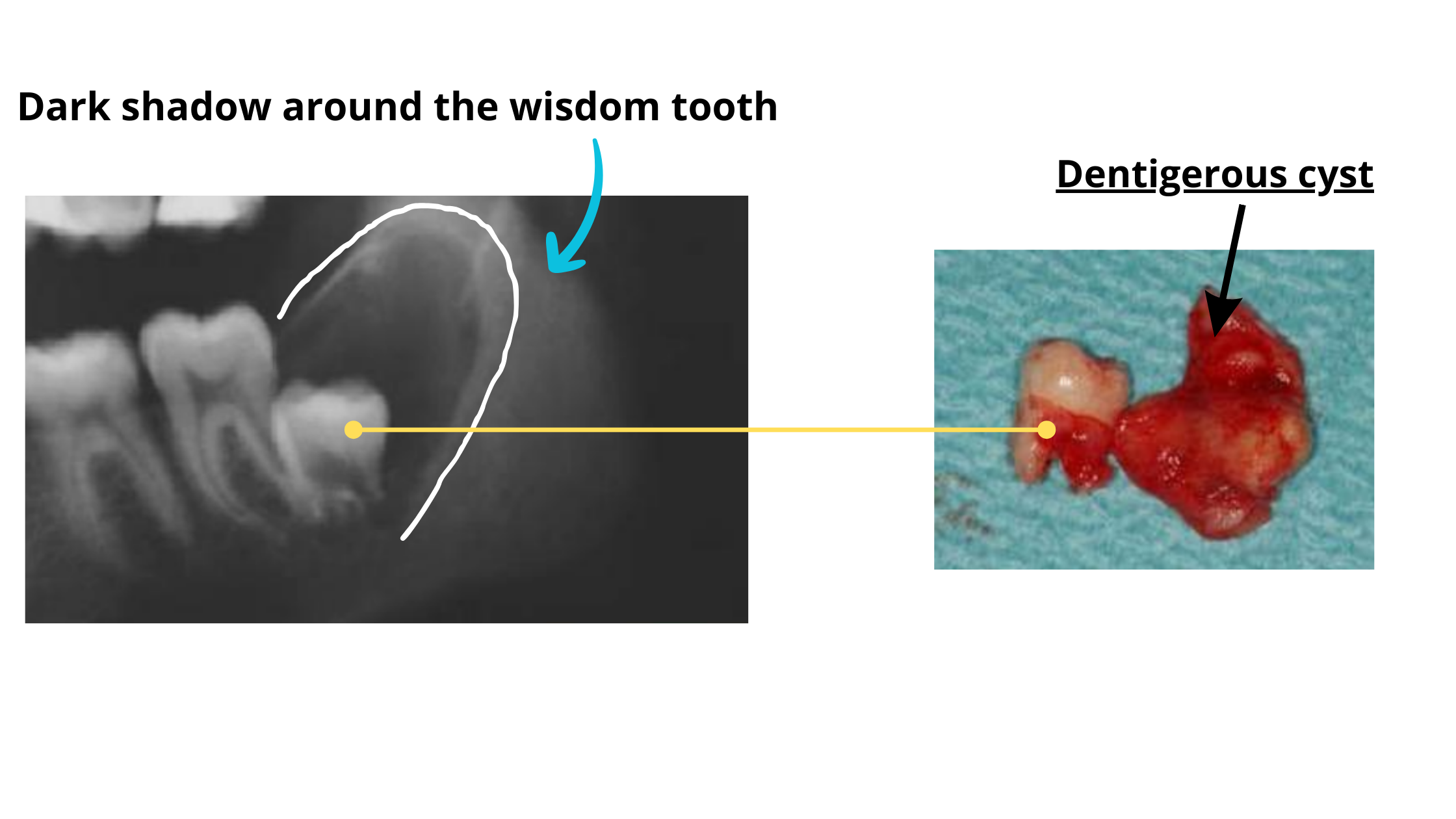 Image of a dentigerous cyst after wisdom tooth extraction with a preoperative X-ray image