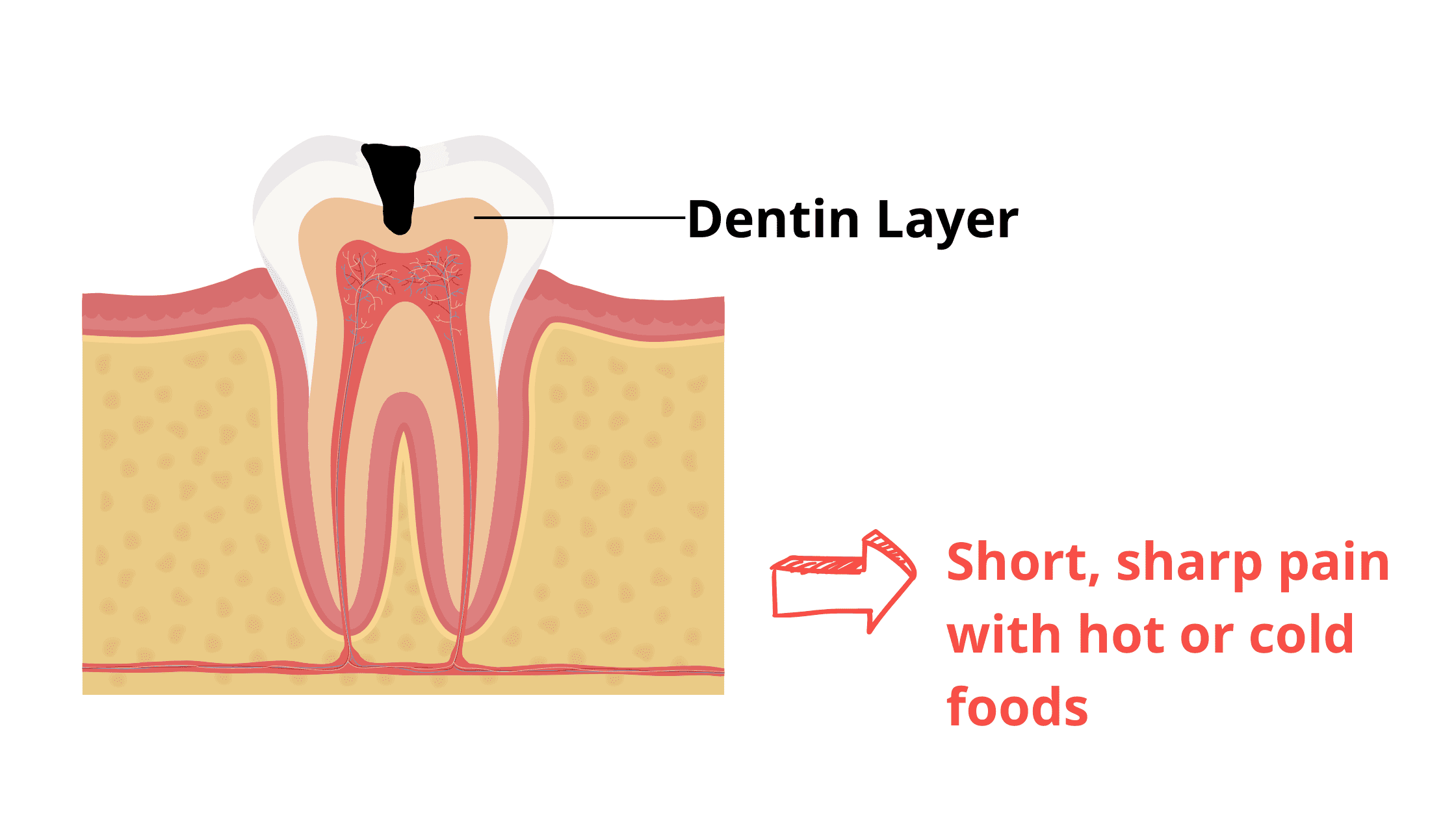 The tooth becomes sensitive when the dentine is affected